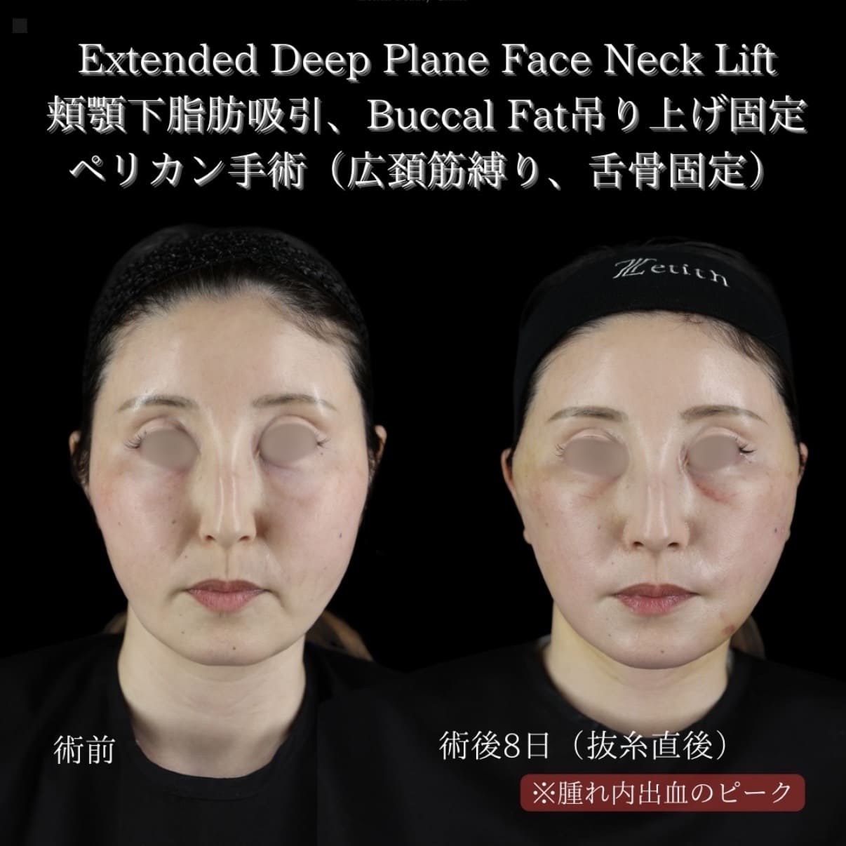 フェイスリフトのビフォーアフター写真