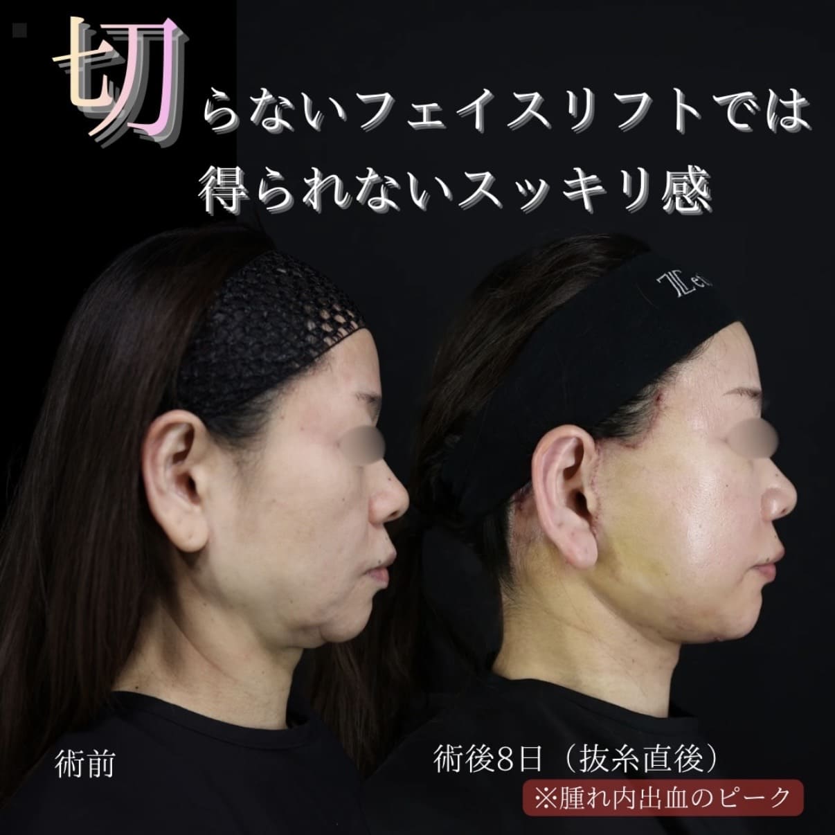 フェイスリフトのビフォーアフター写真