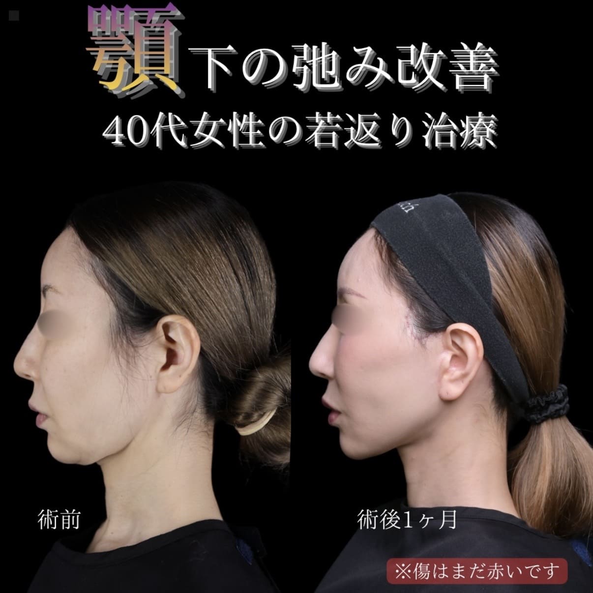 フェイスリフトのビフォーアフター写真
