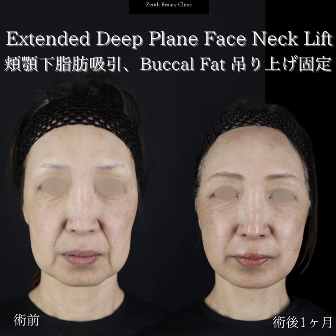 フェイスリフトのビフォーアフター写真