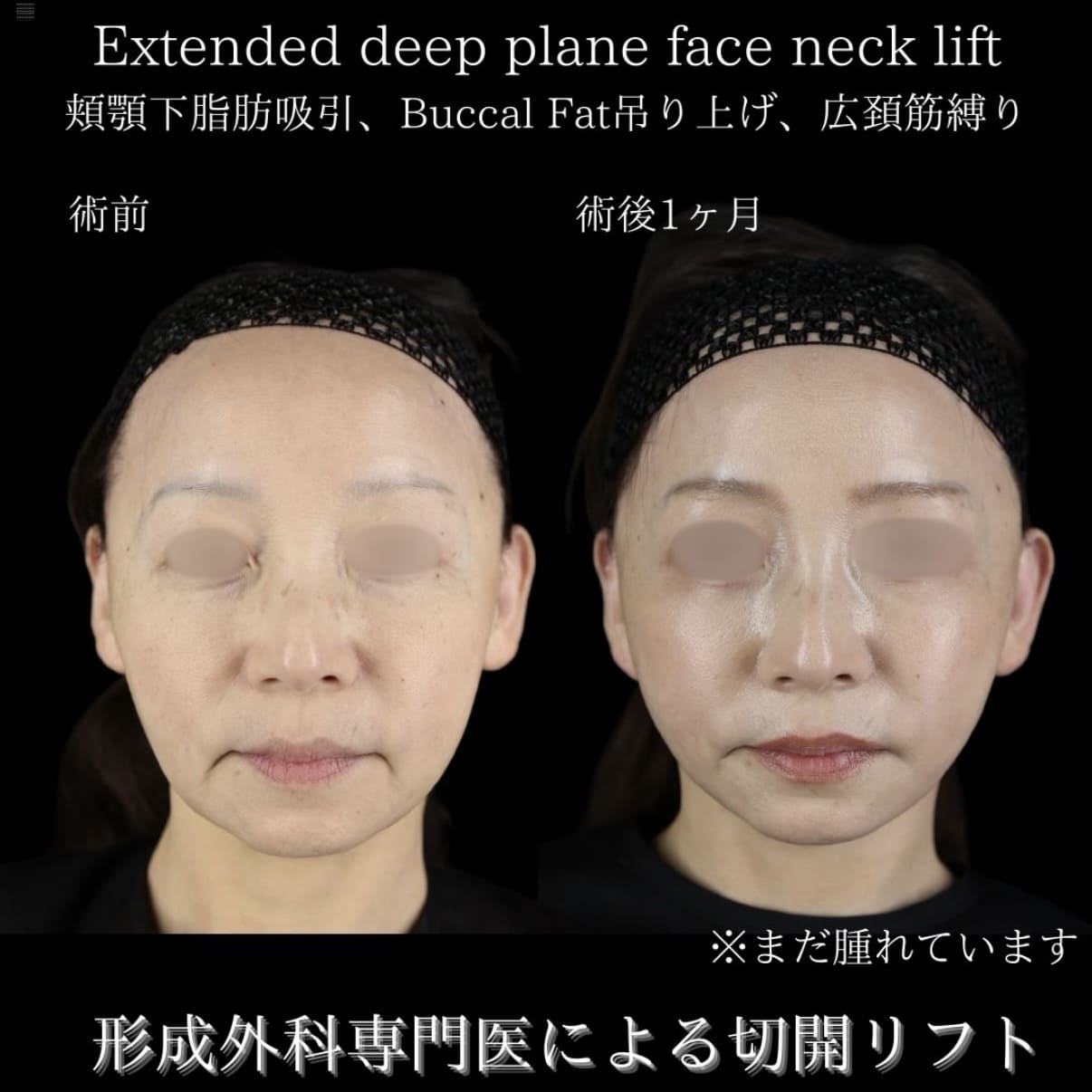 フェイスリフトのビフォーアフター写真