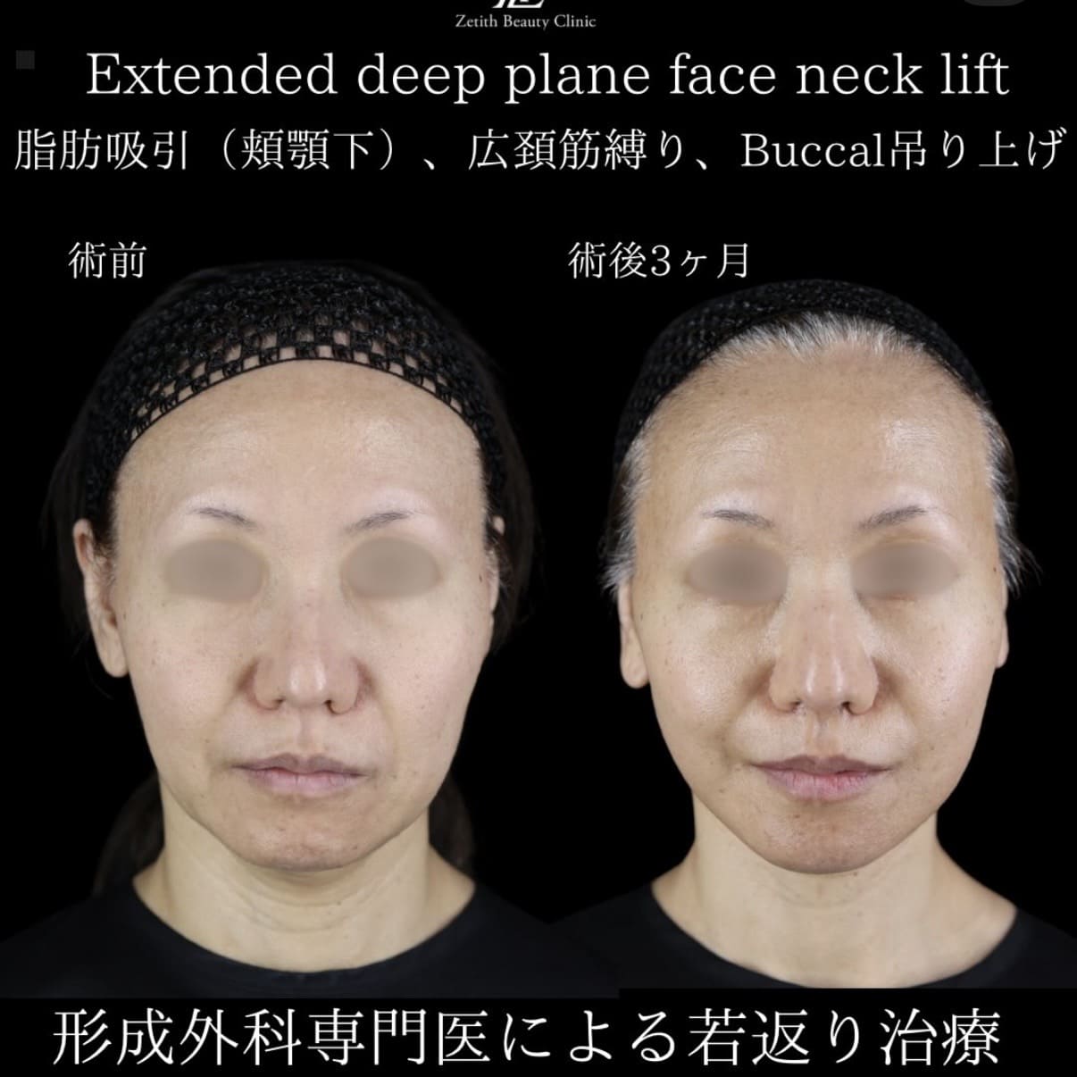 フェイスリフトのビフォーアフター写真