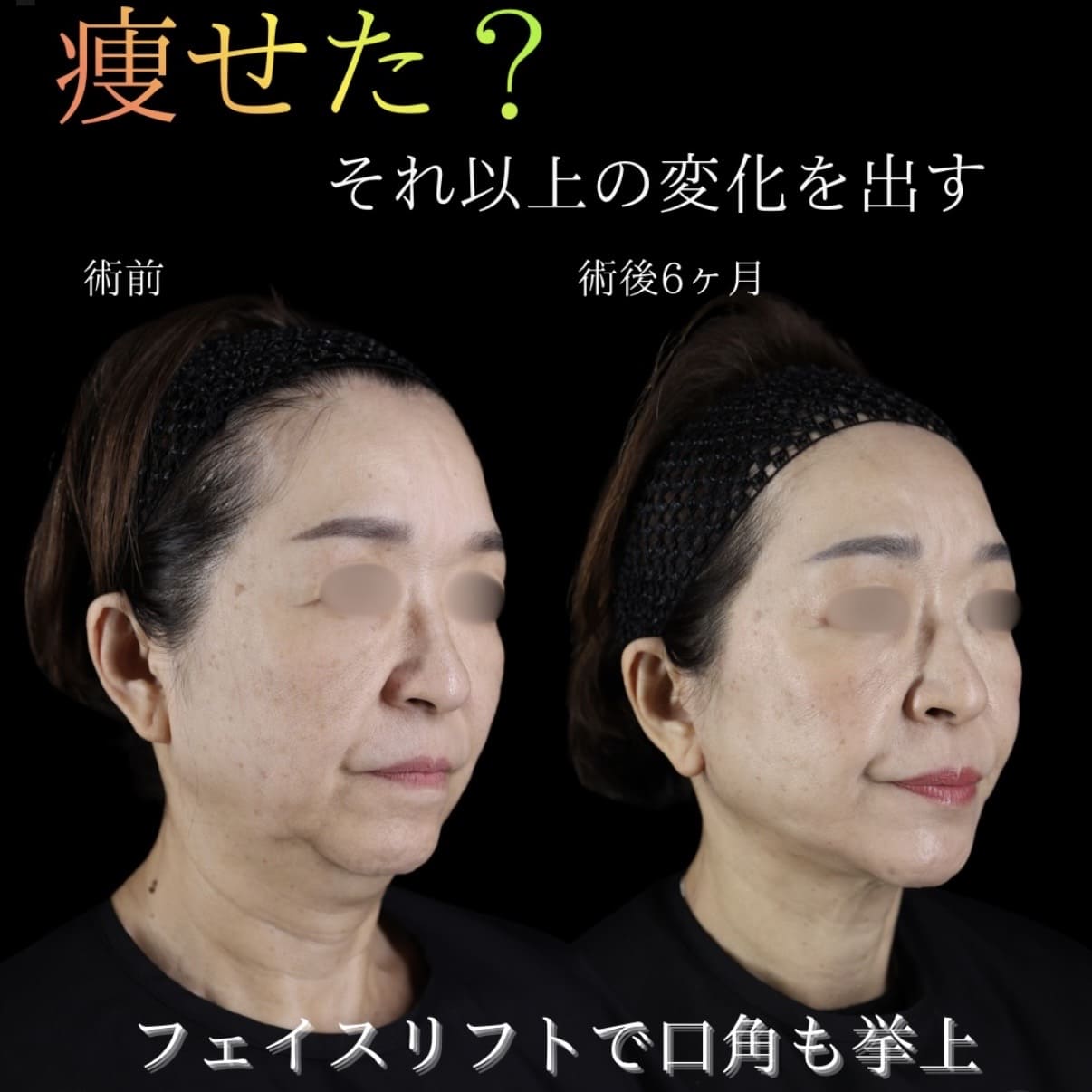 フェイスリフトのビフォーアフター写真