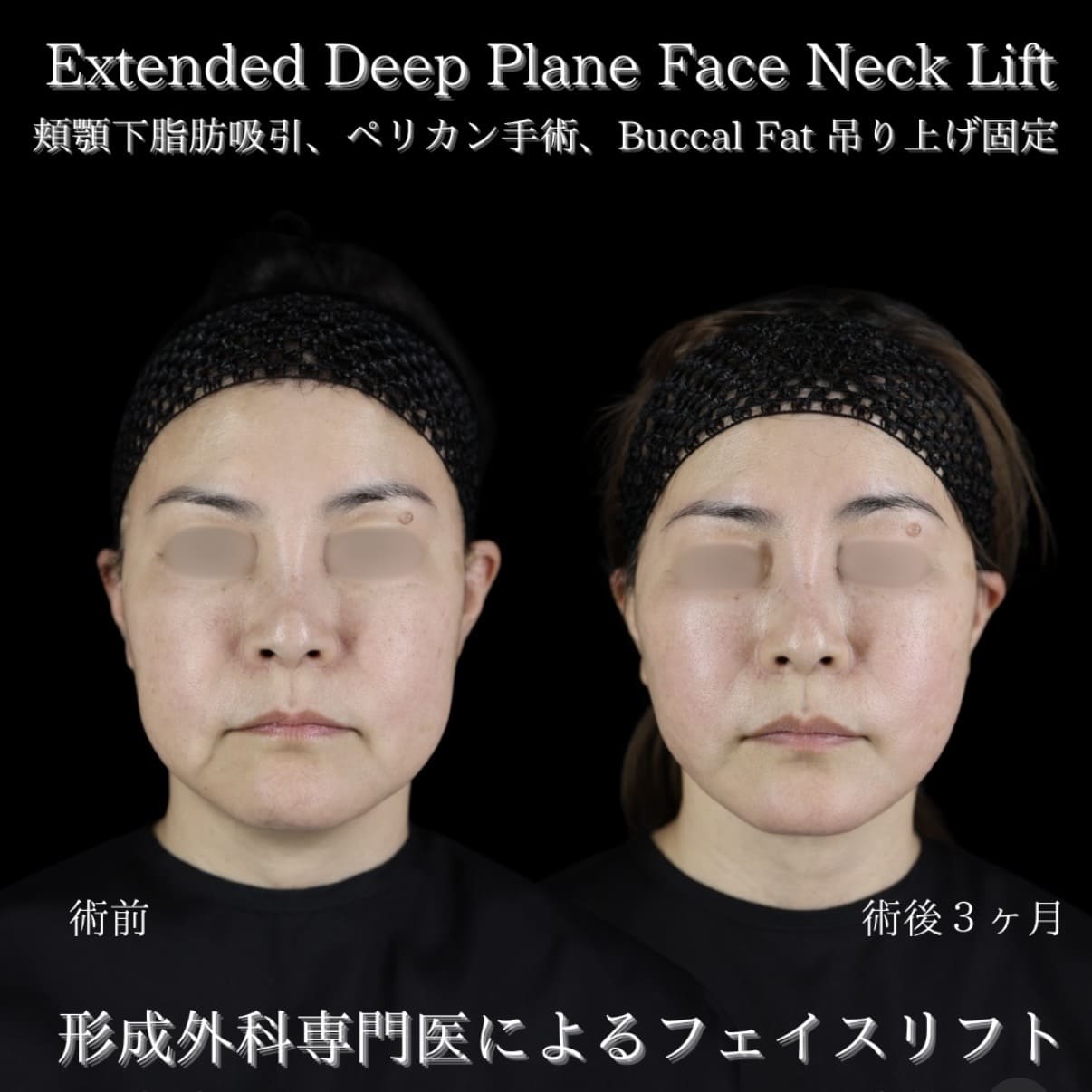 フェイスリフトのビフォーアフター写真