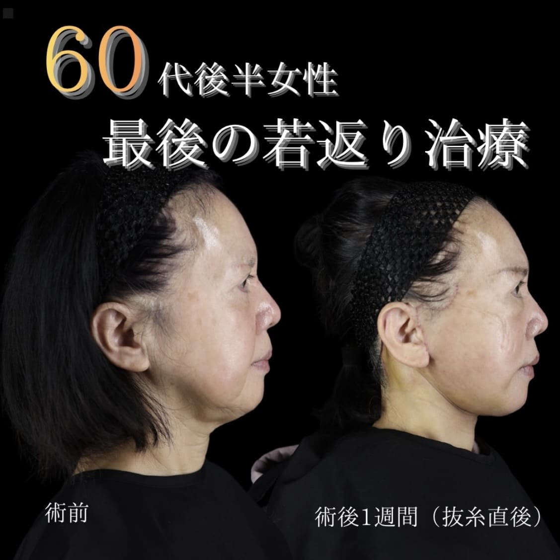 フェイスリフトのビフォーアフター写真