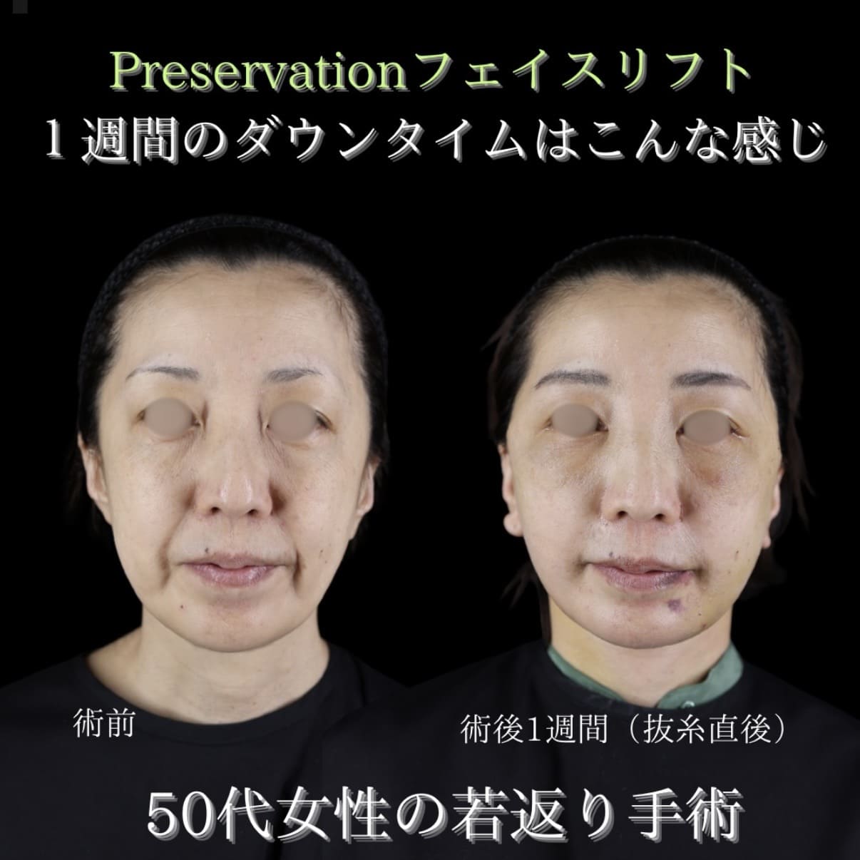 フェイスリフトのビフォーアフター写真