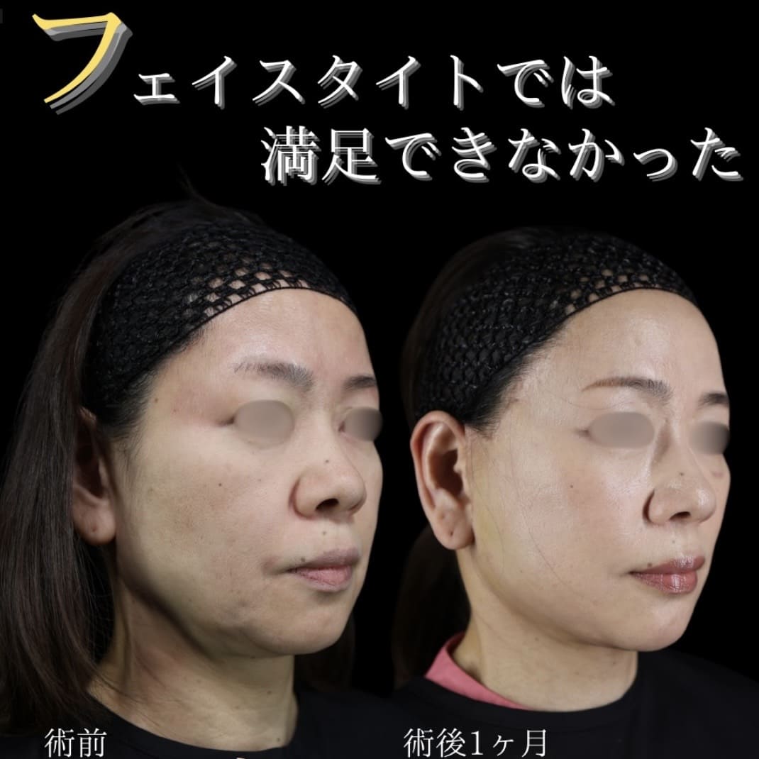 フェイスリフトのビフォーアフター写真