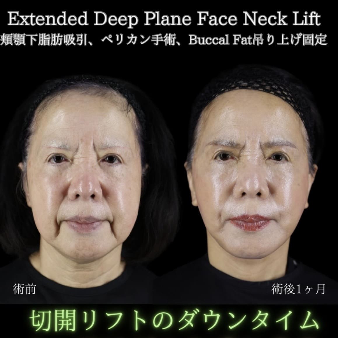 フェイスリフトのビフォーアフター写真