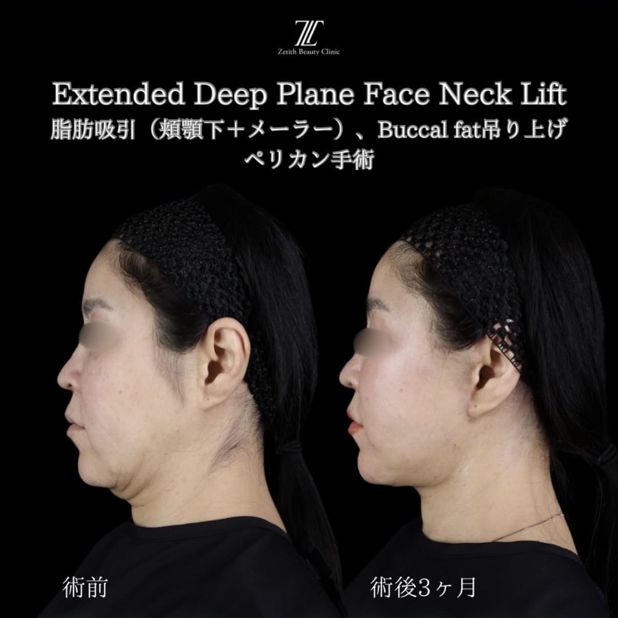 フェイスリフトのビフォーアフター写真