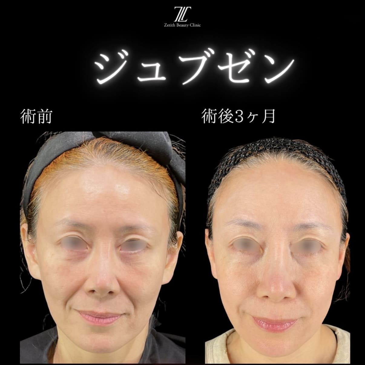 ジュブゼンのビフォーアフター写真
