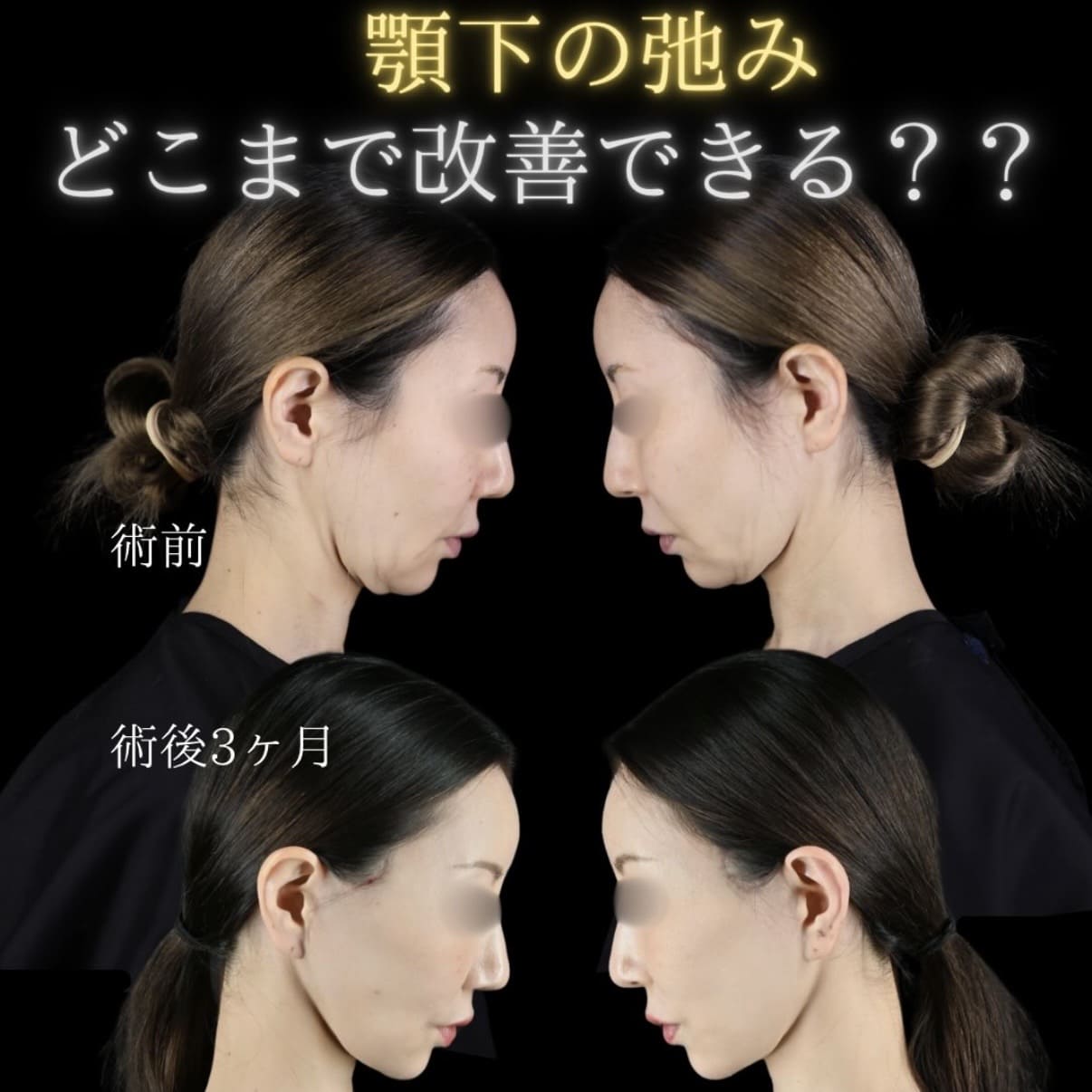 フェイスリフトのビフォーアフター写真