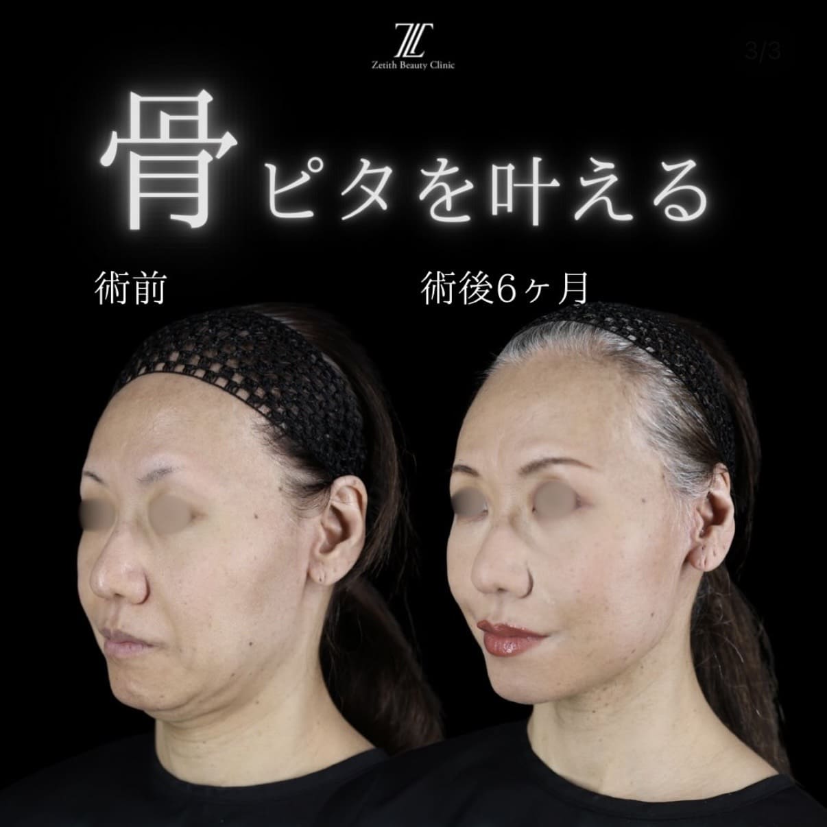 フェイスリフトのビフォーアフター写真