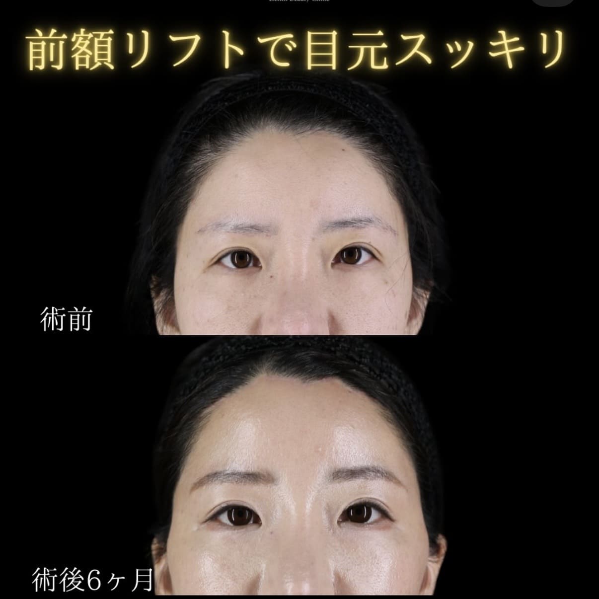 前額リフトのビフォーアフター写真