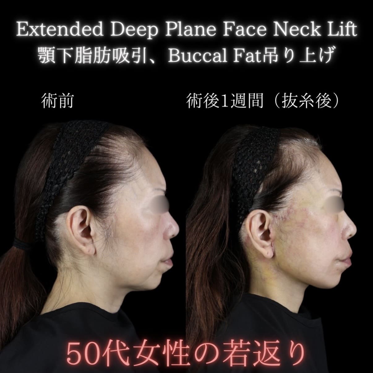 フェイスリフトのビフォーアフター写真