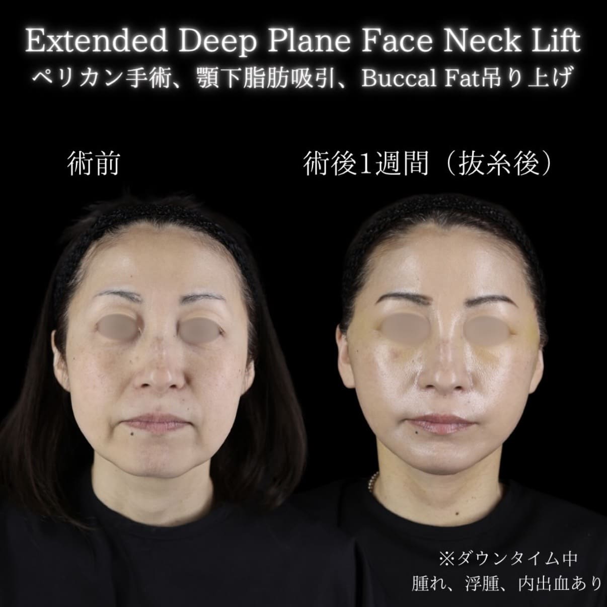 フェイスリフトのビフォーアフター写真