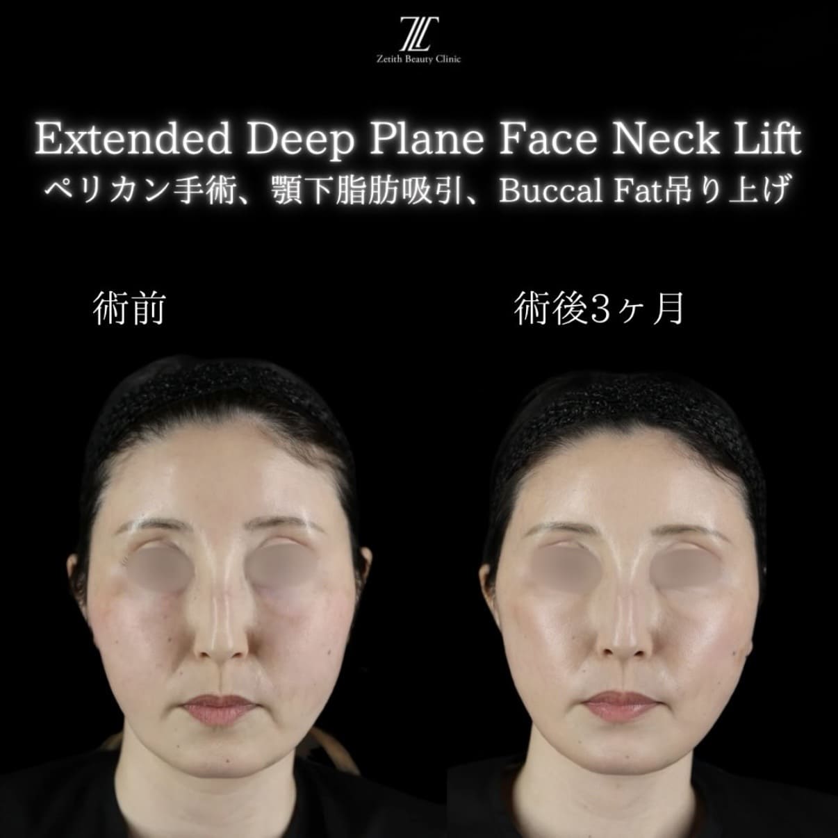 フェイスリフトのビフォーアフター写真