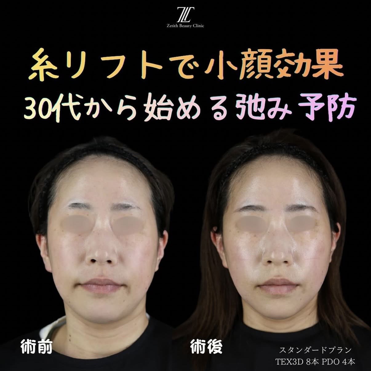 糸リフトのビフォーアフター写真