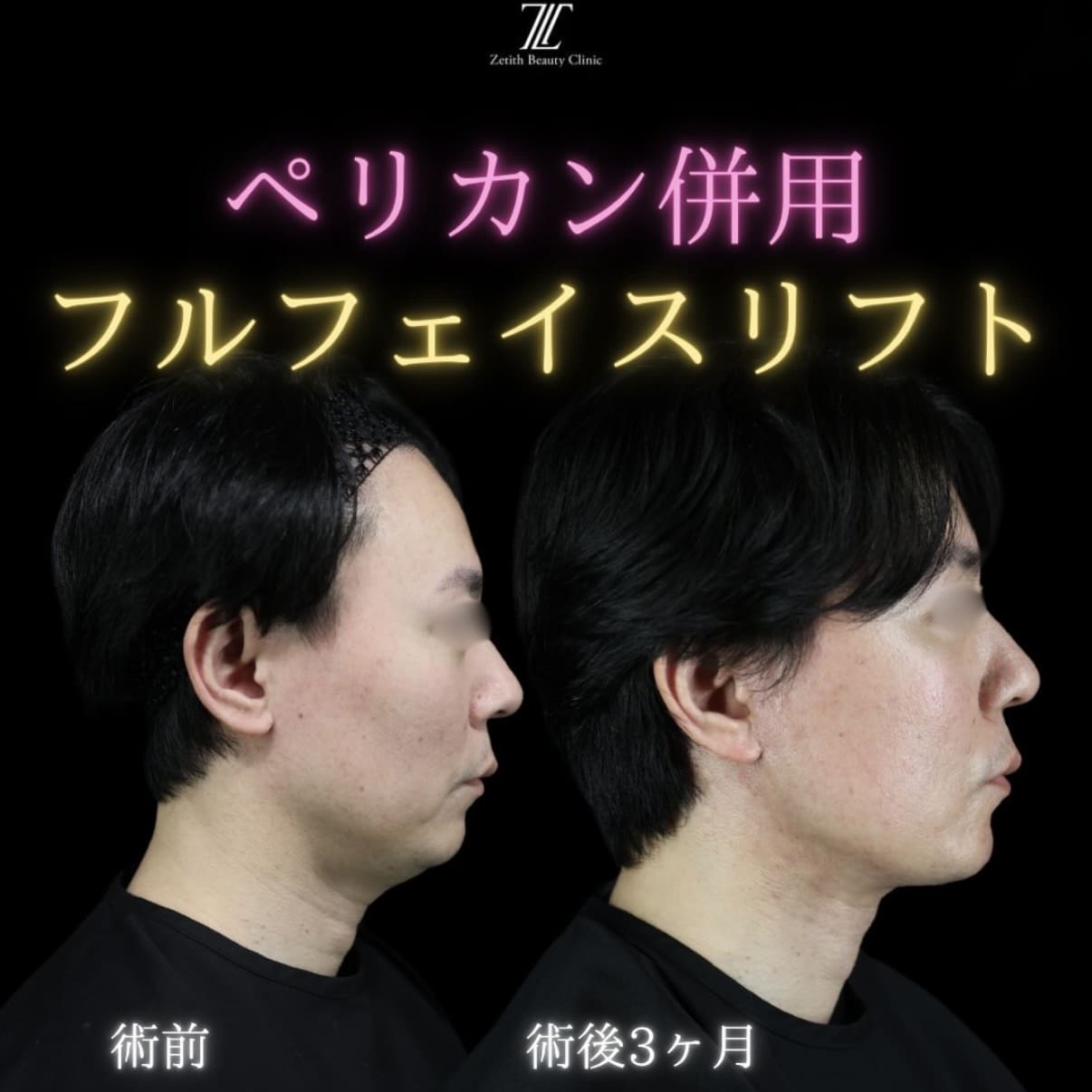 フェイスリフトのビフォーアフター写真