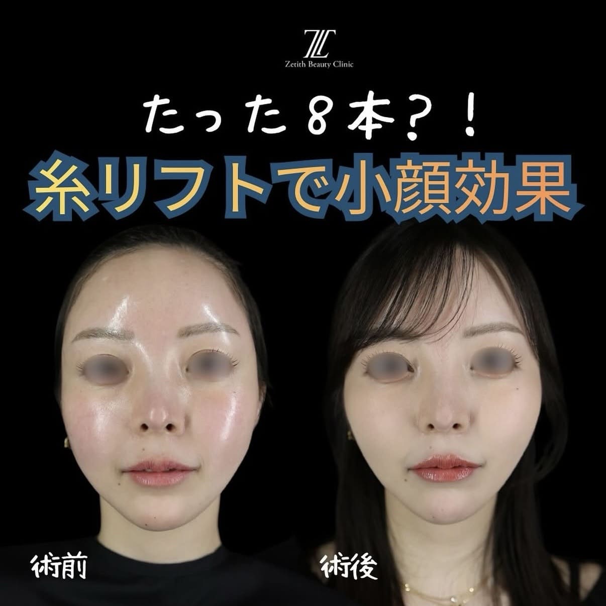 糸リフトのビフォーアフター写真