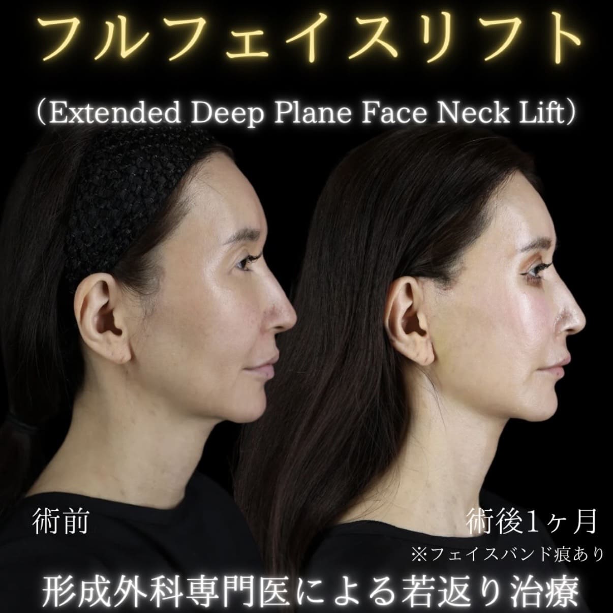 フェイスリフトのビフォーアフター写真
