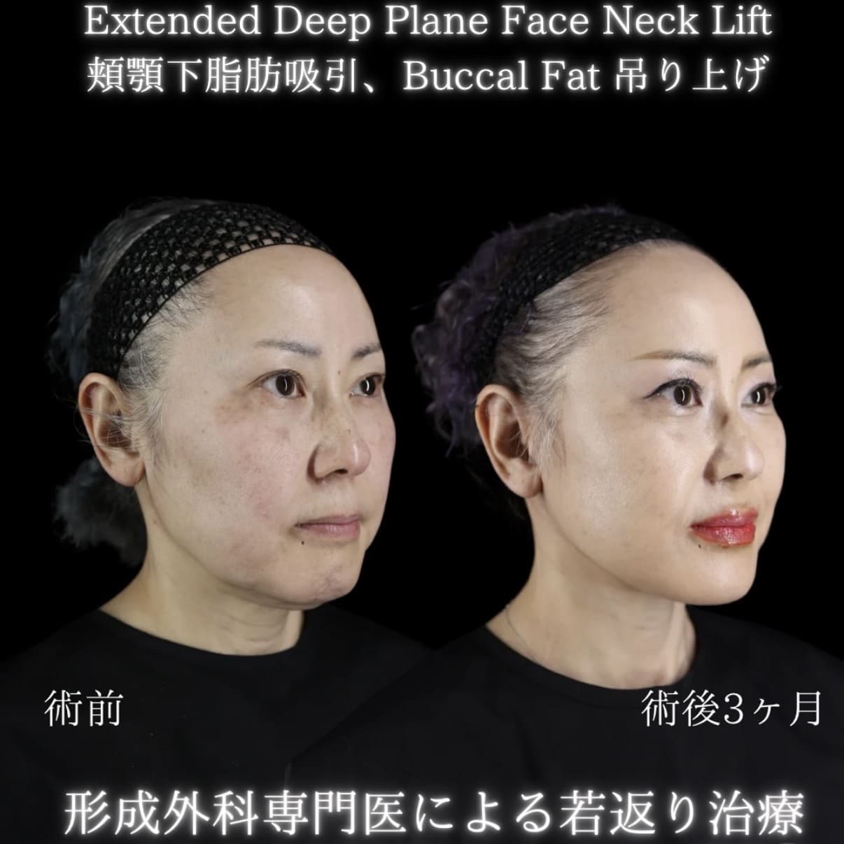フェイスリフトのビフォーアフター写真