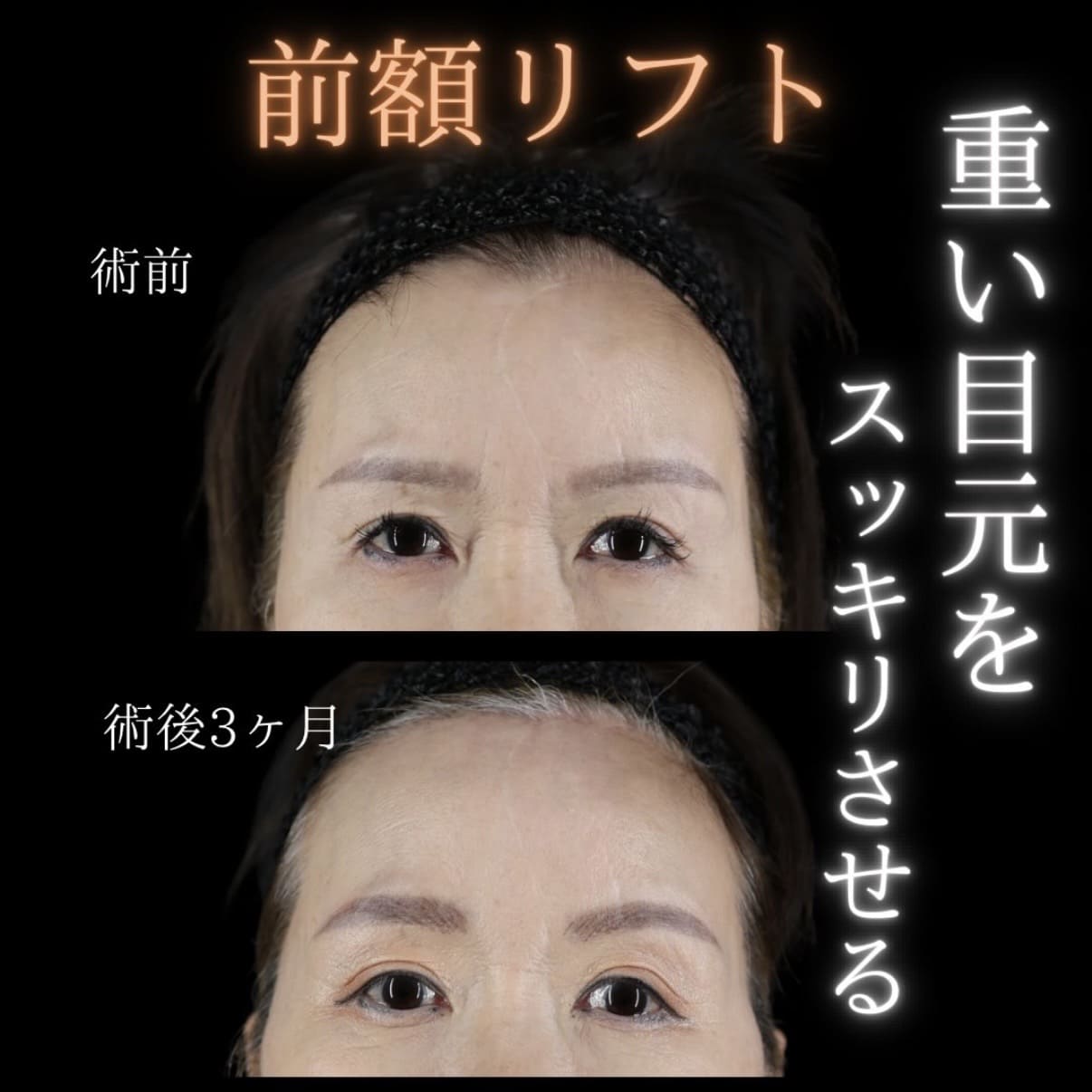 前額リフトのビフォーアフター写真