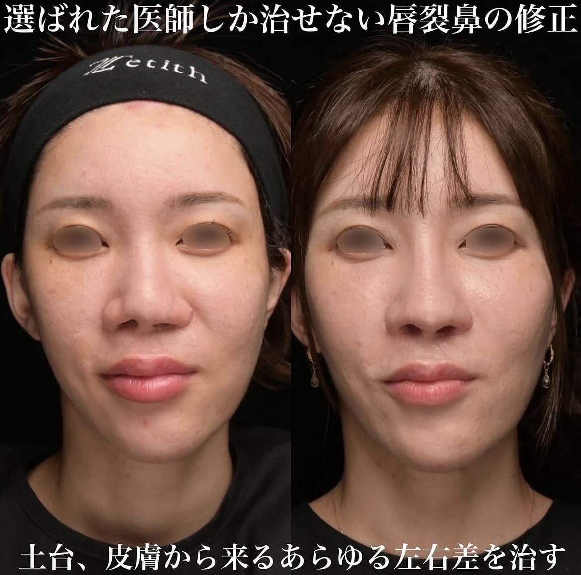 鼻整形のビフォーアフター写真