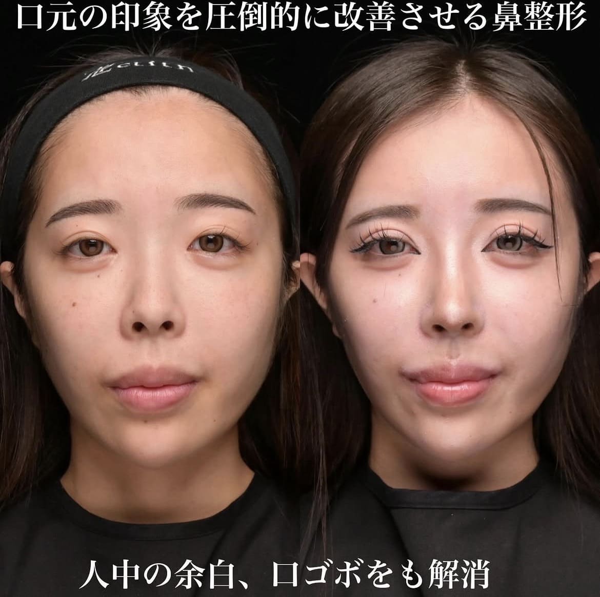 鼻整形のビフォーアフター写真
