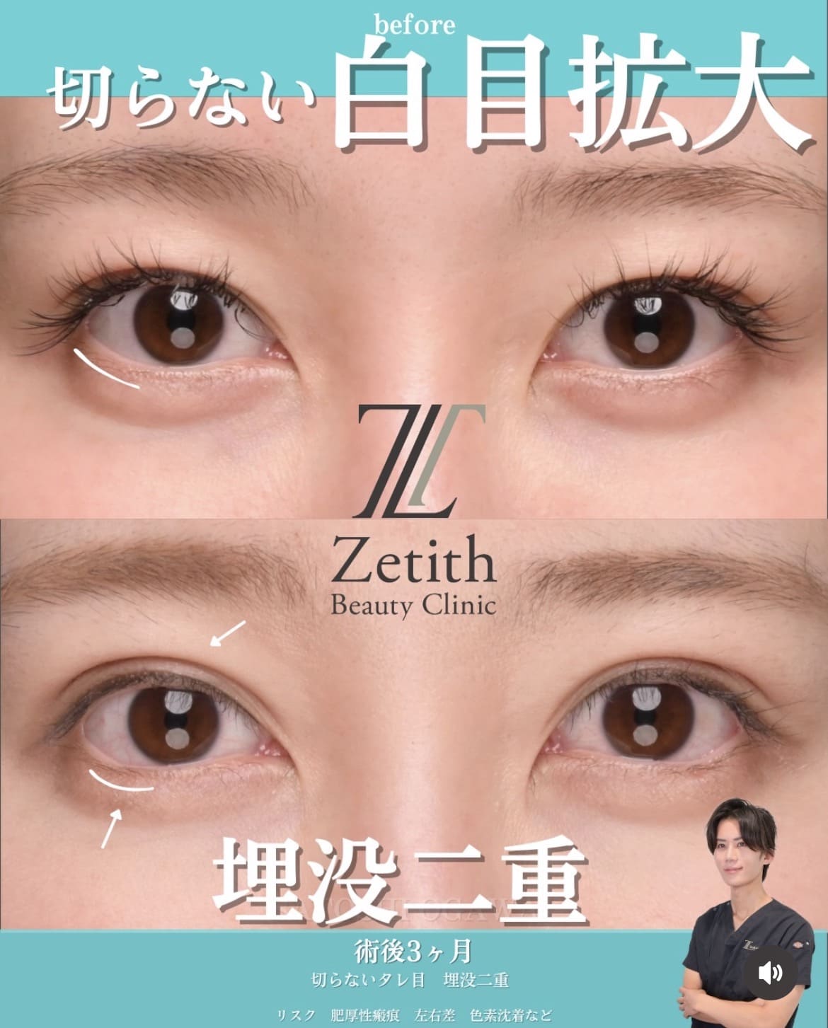 目元整形のビフォーアフター