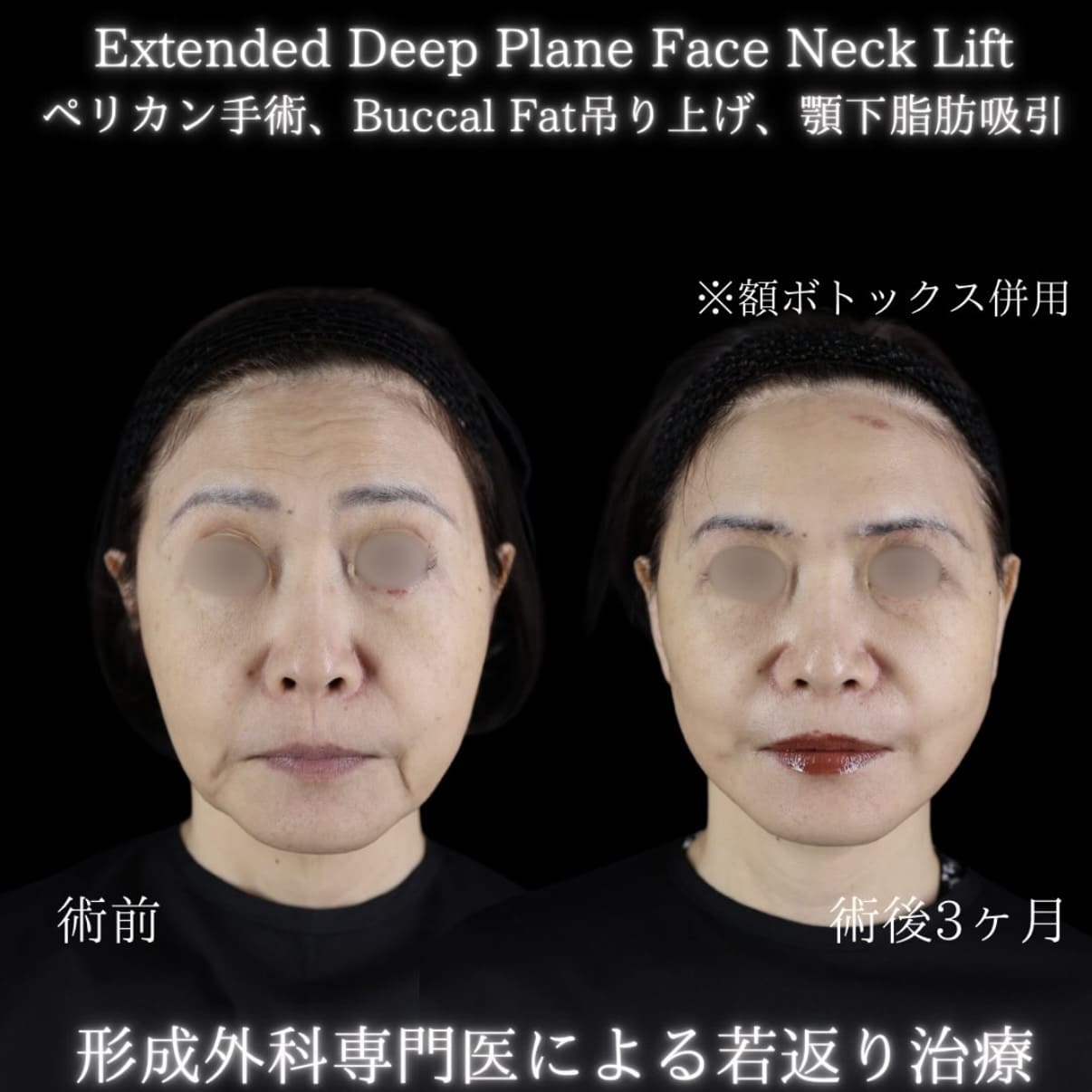 フェイスリフトのビフォーアフター写真