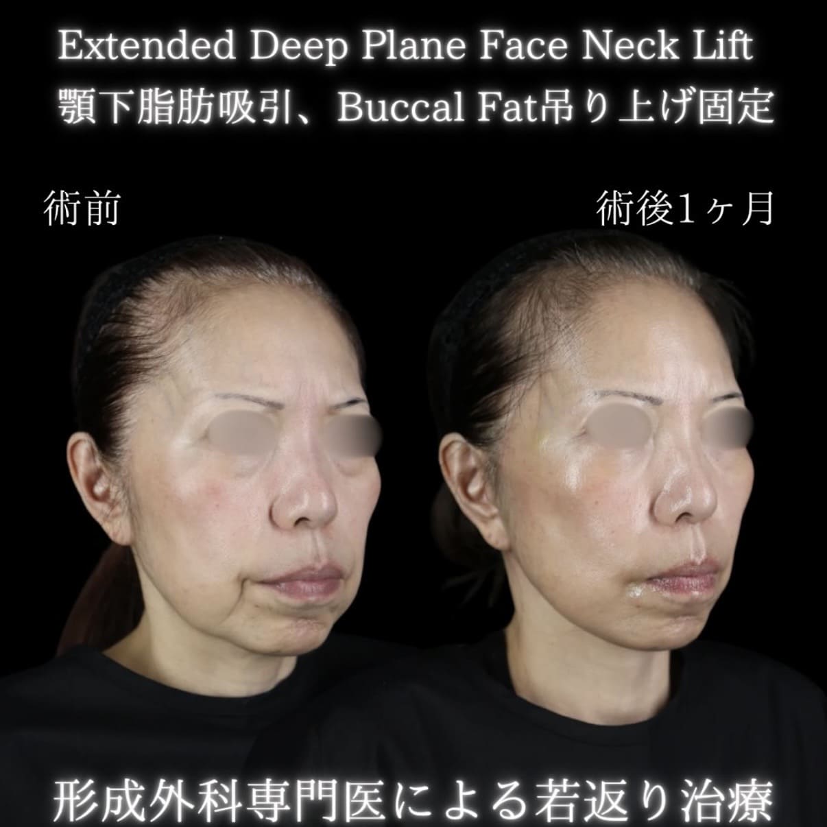 フェイスリフトのビフォーアフター写真
