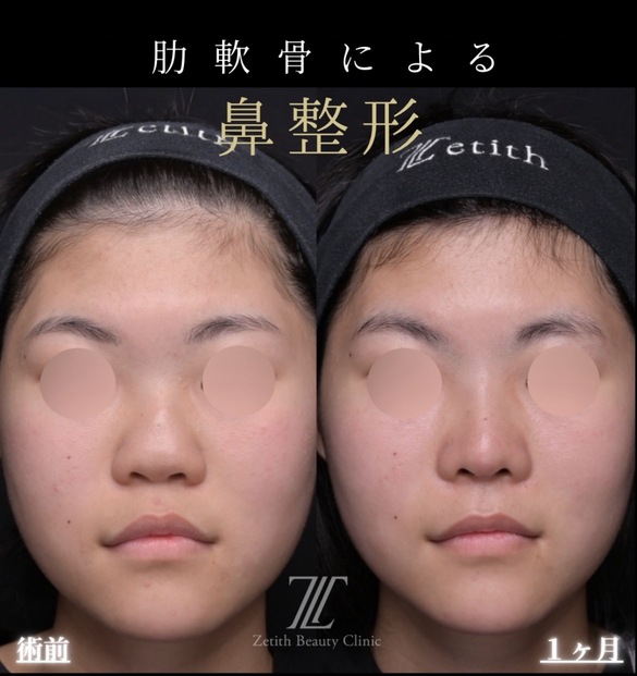 鼻整形のビフォーアフター写真