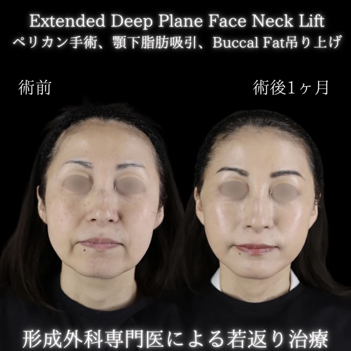 フェイスリフトのビフォーアフター写真