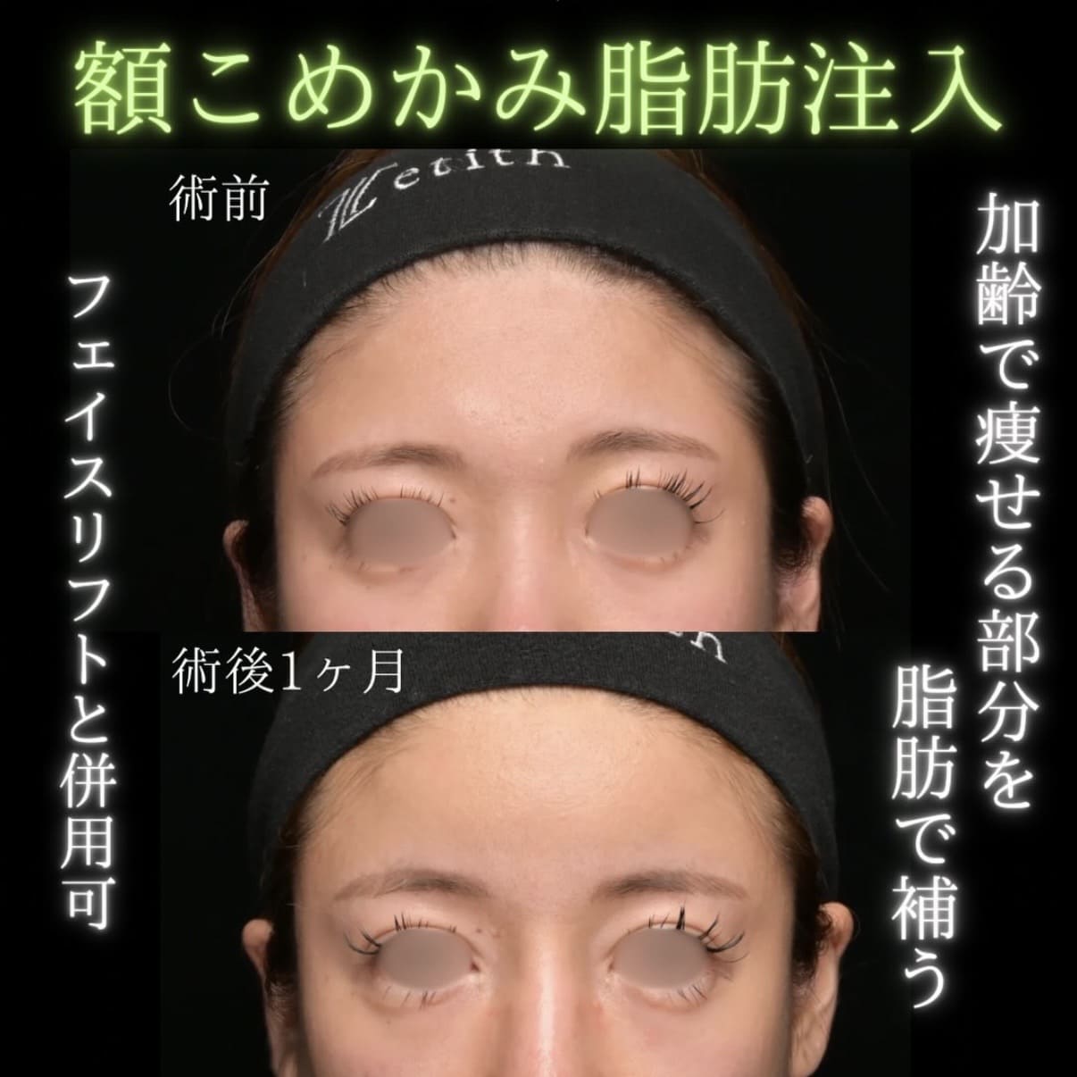 脂肪注入のビフォーアフター写真
