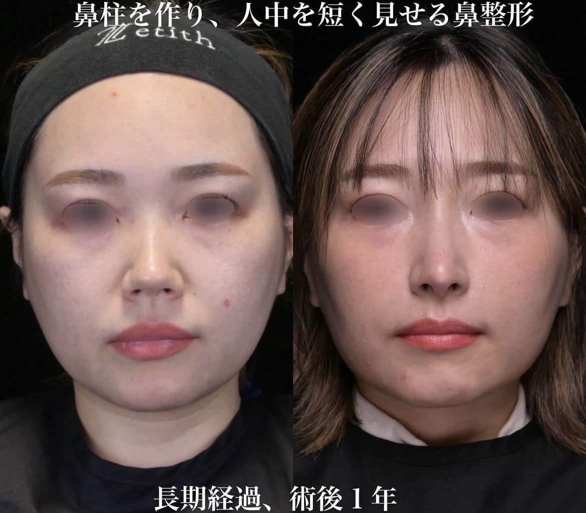 鼻整形のビフォーアフター写真
