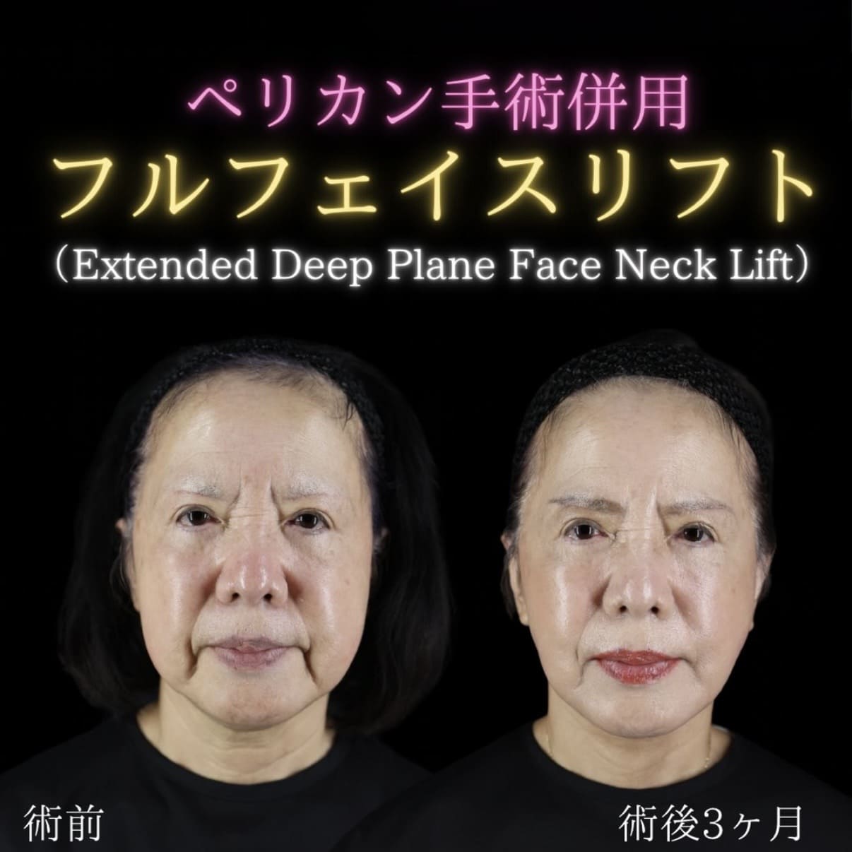 フェイスリフトのビフォーアフター写真