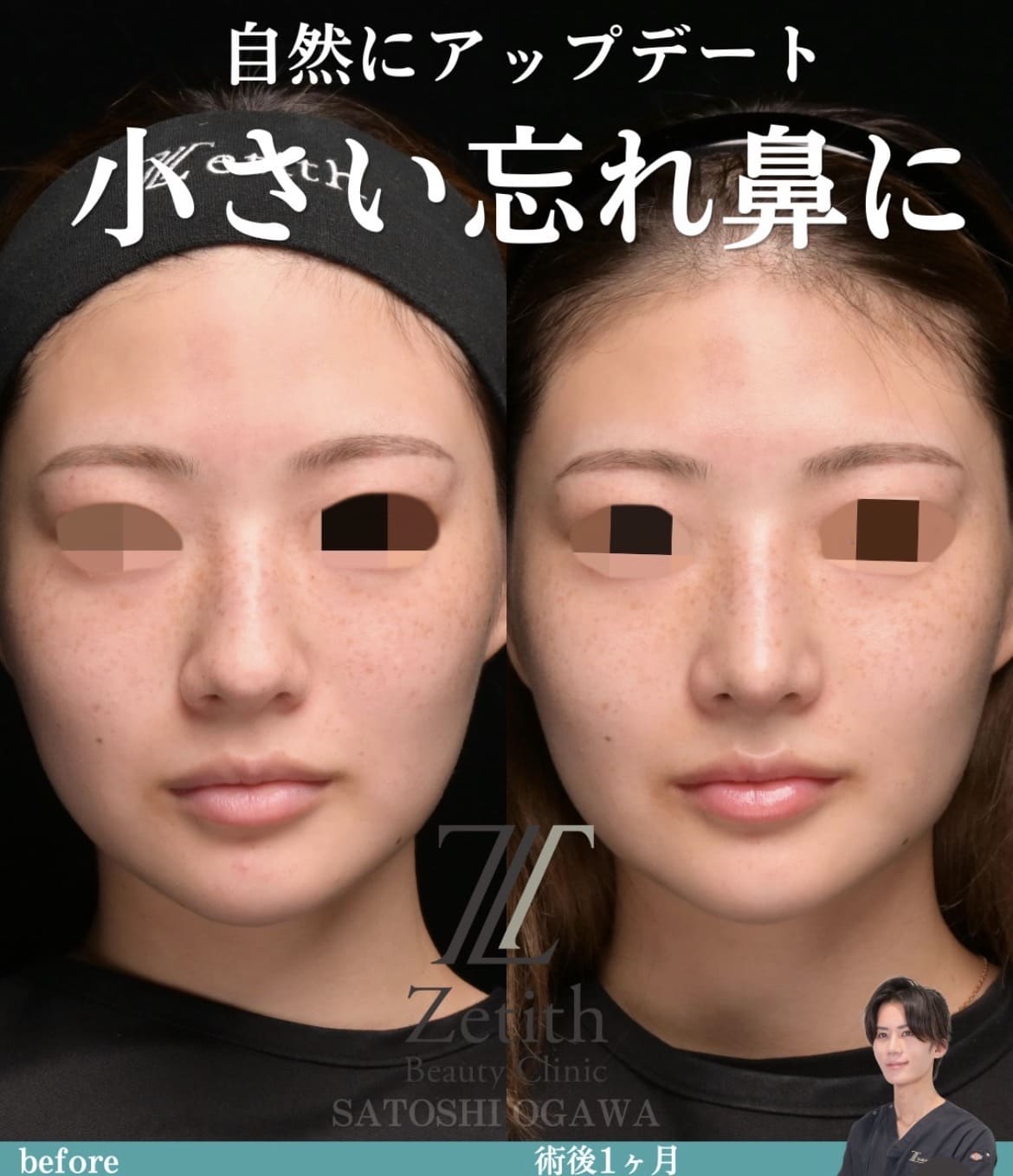 鼻整形のビフォーアフター写真