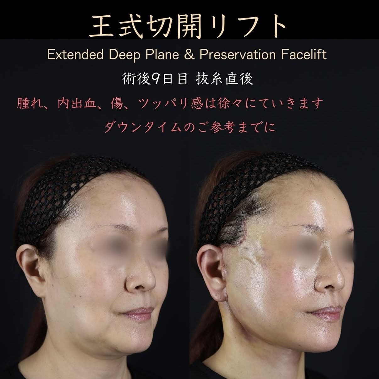 フェイスリフトのビフォーアフター写真