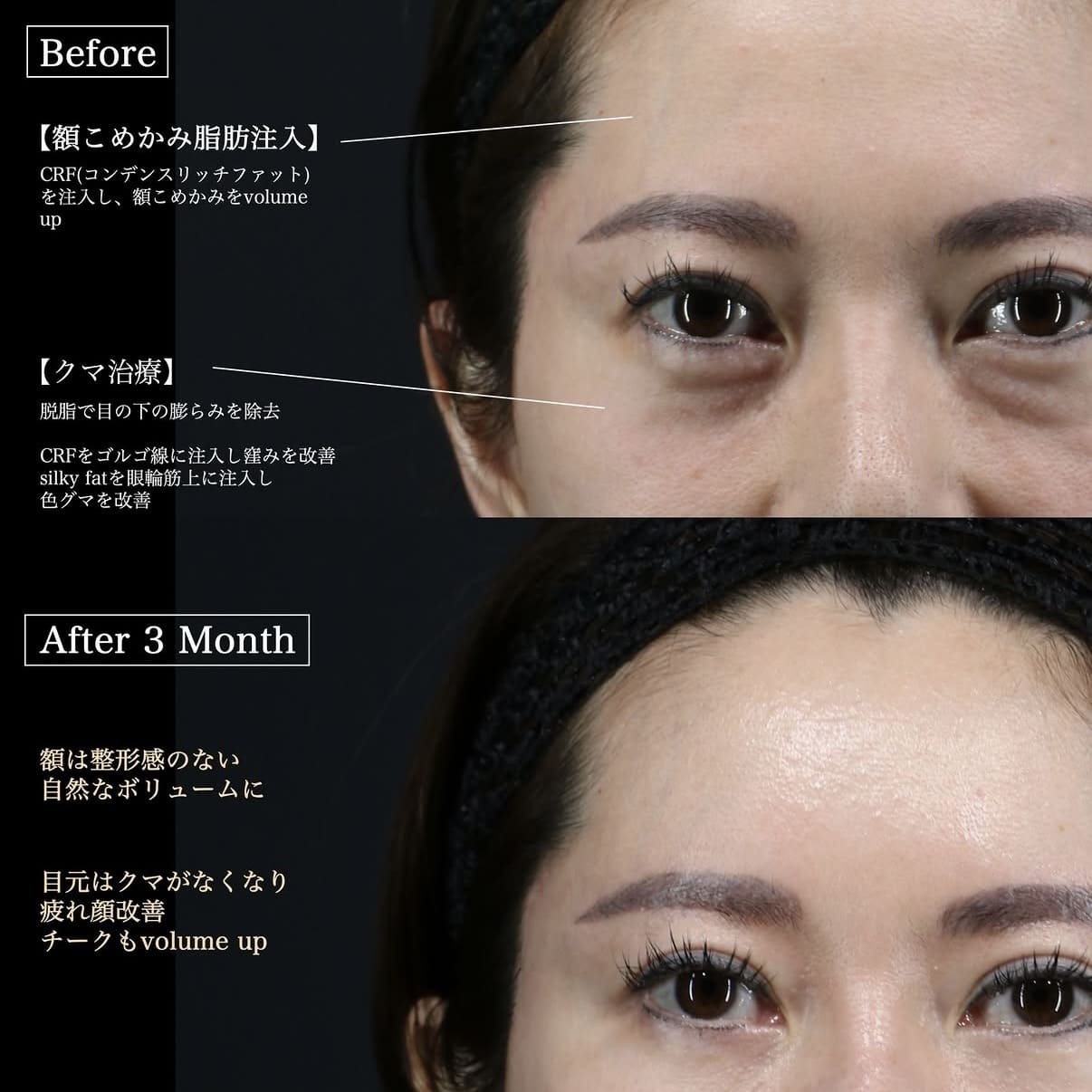 脂肪注入、クマ取りのビフォーアフター写真