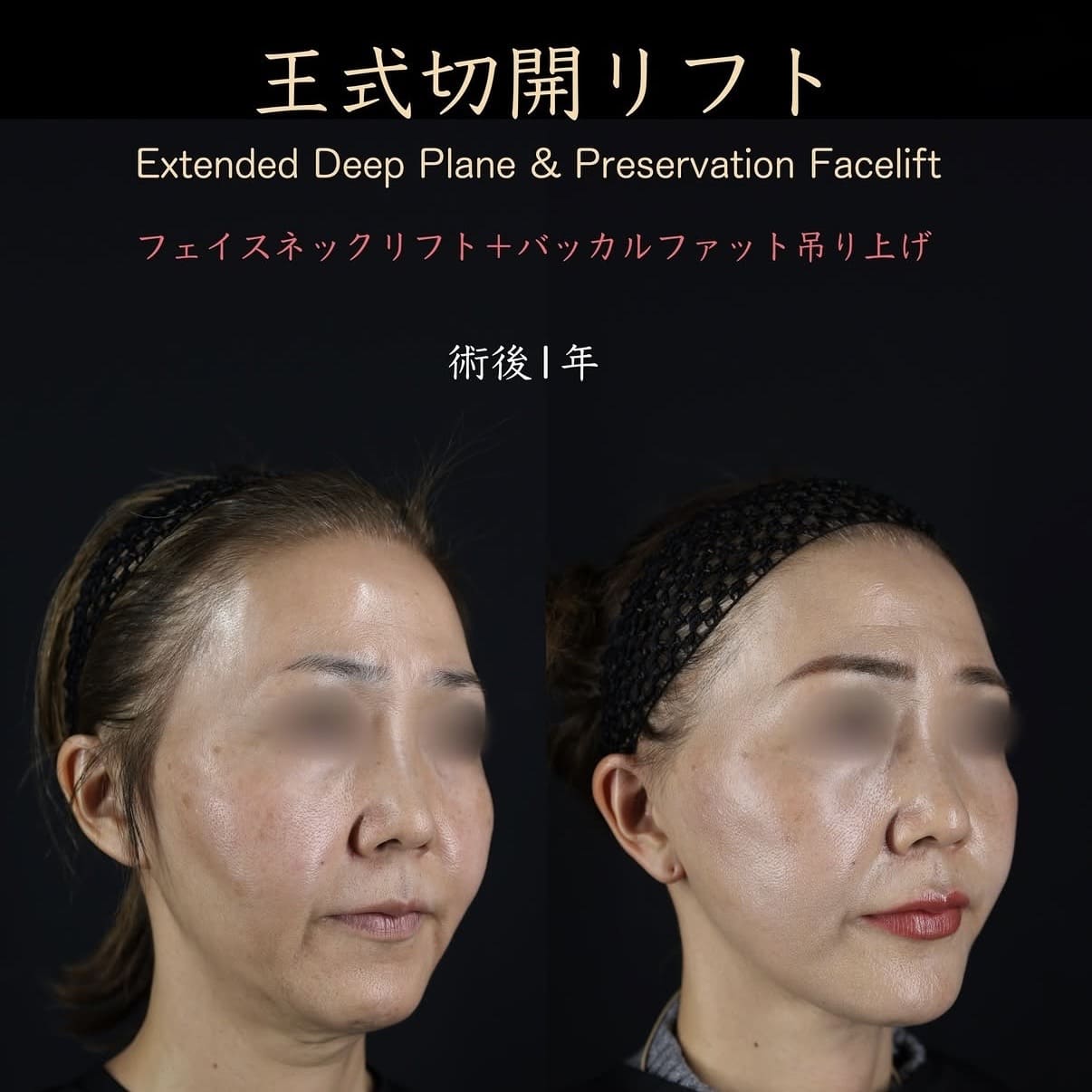 フェイスリフトのビフォーアフター写真