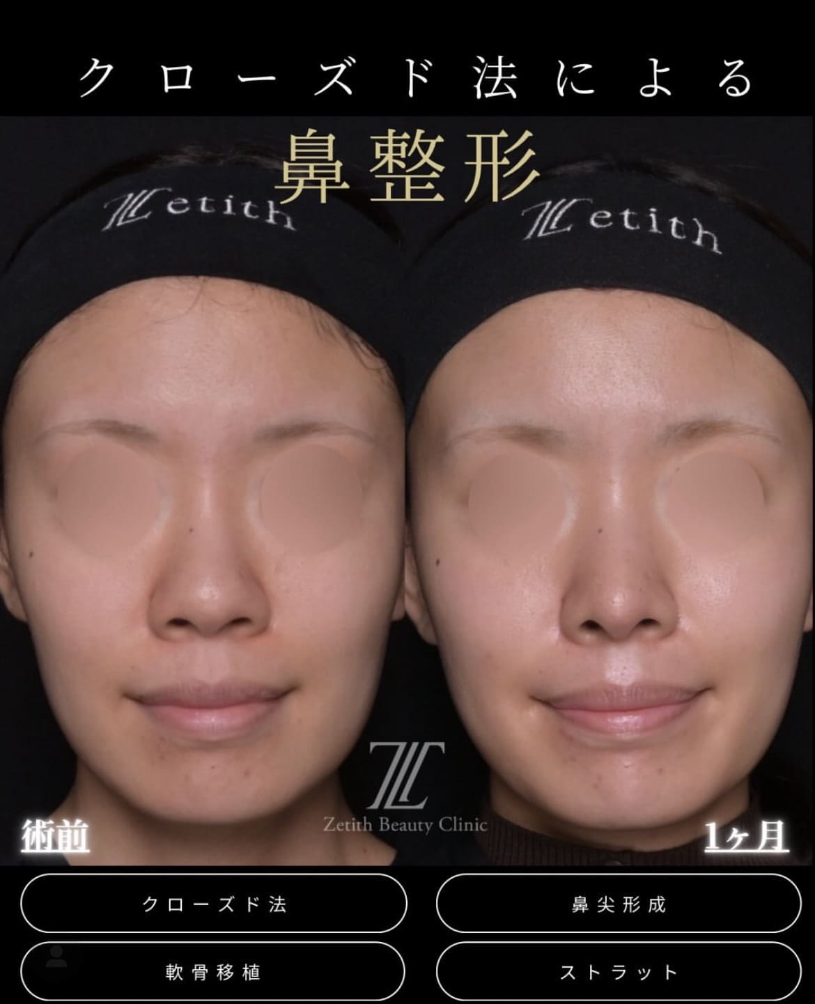 鼻整形のビフォーアフター写真