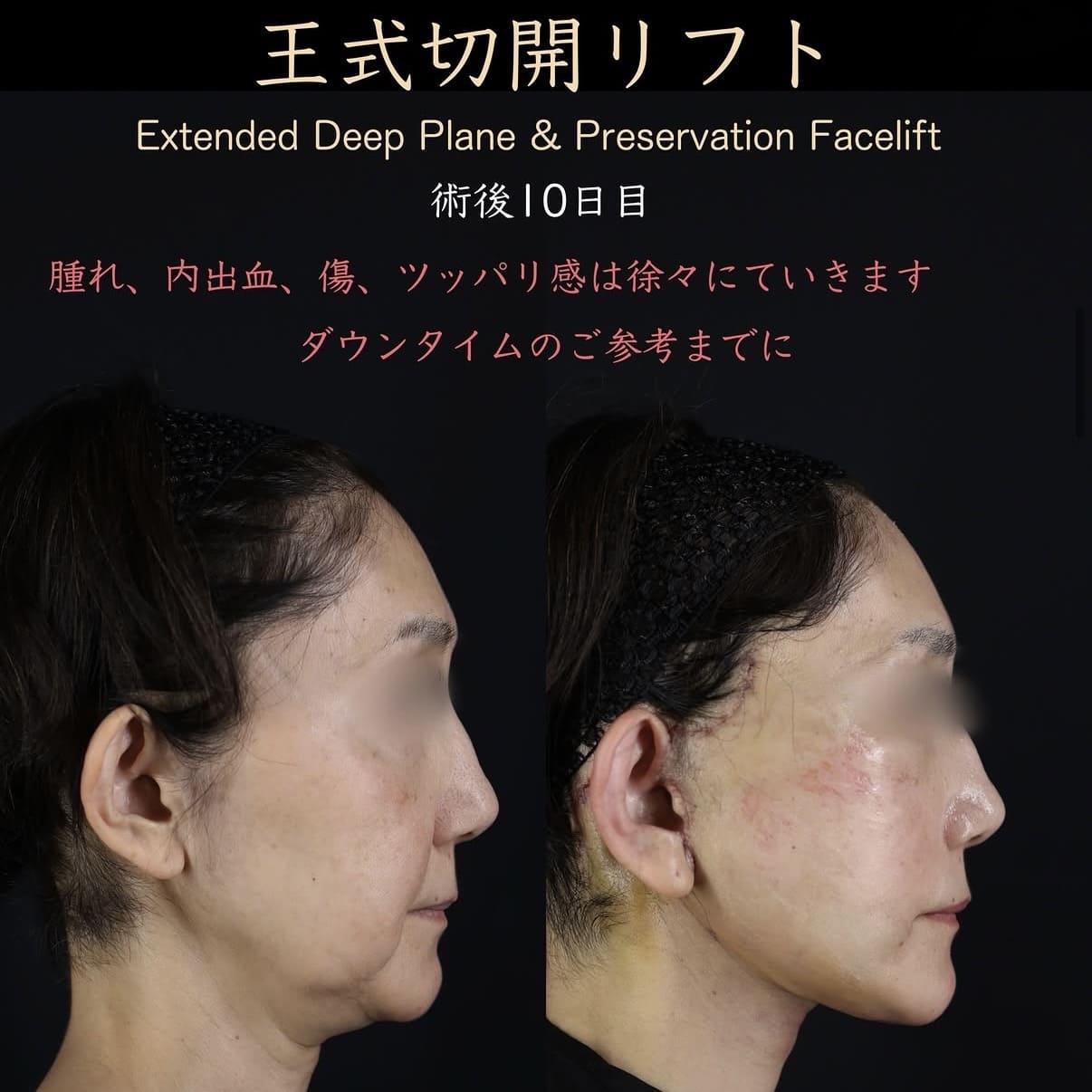 フェイスリフトのビフォーアフター写真