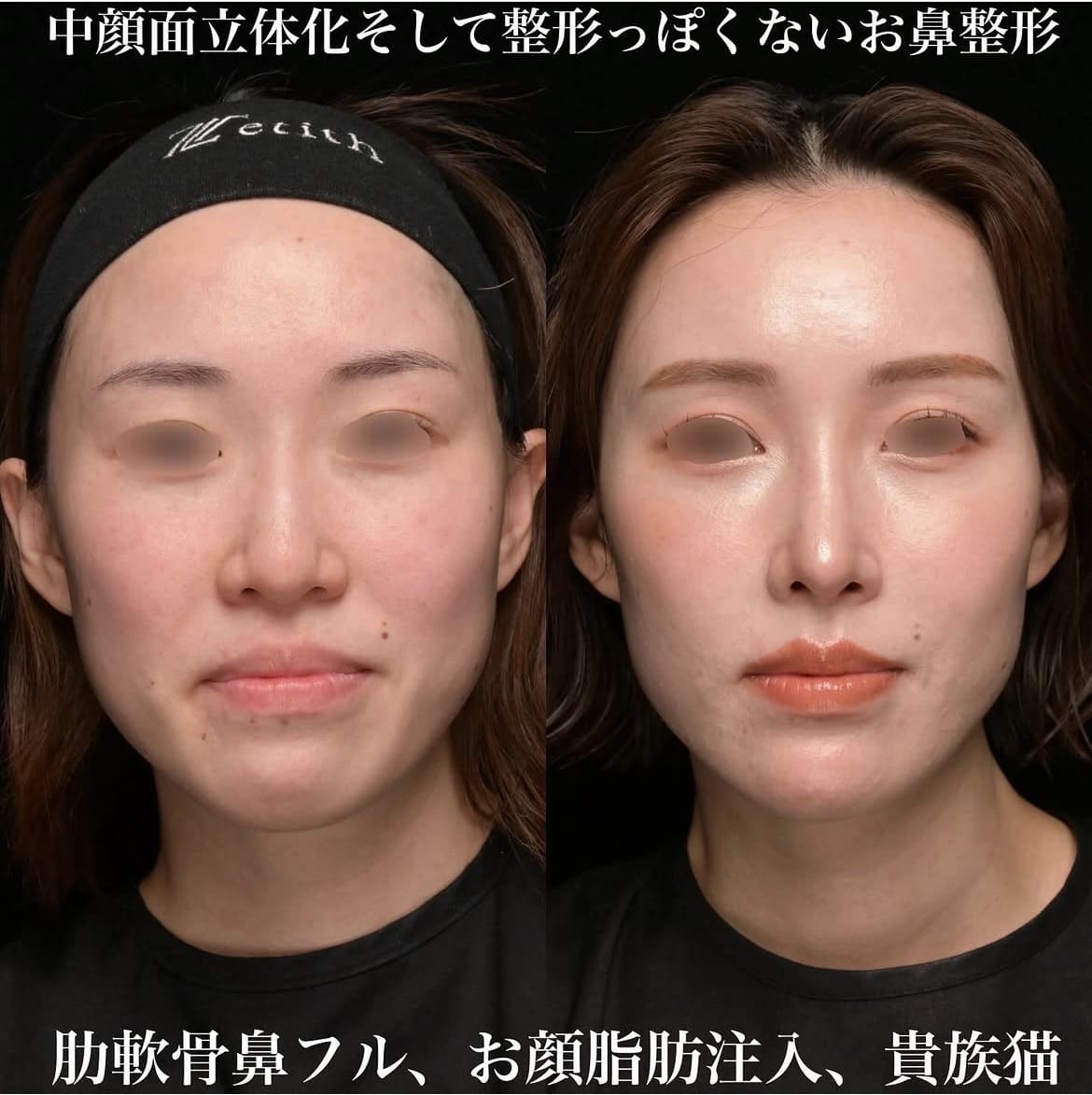 鼻整形のビフォーアフター写真