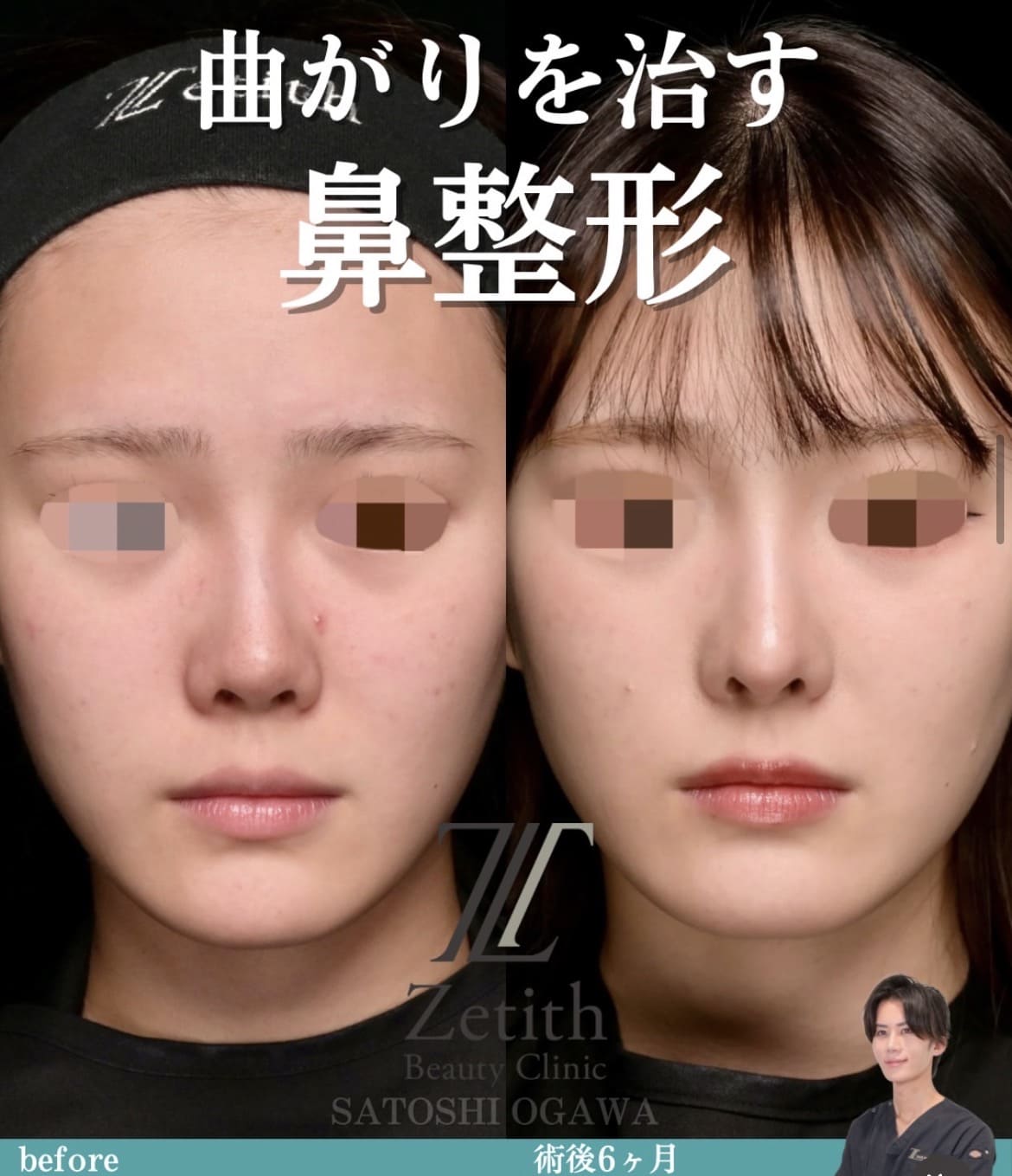 鼻整形のビフォーアフター写真