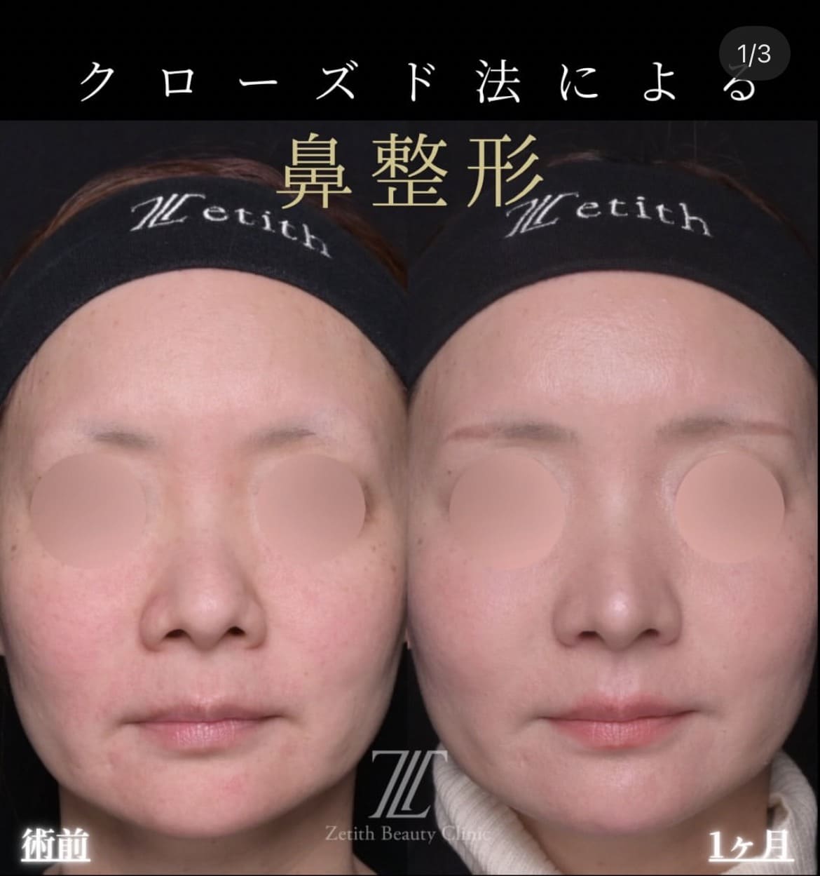 鼻整形のビフォーアフター写真