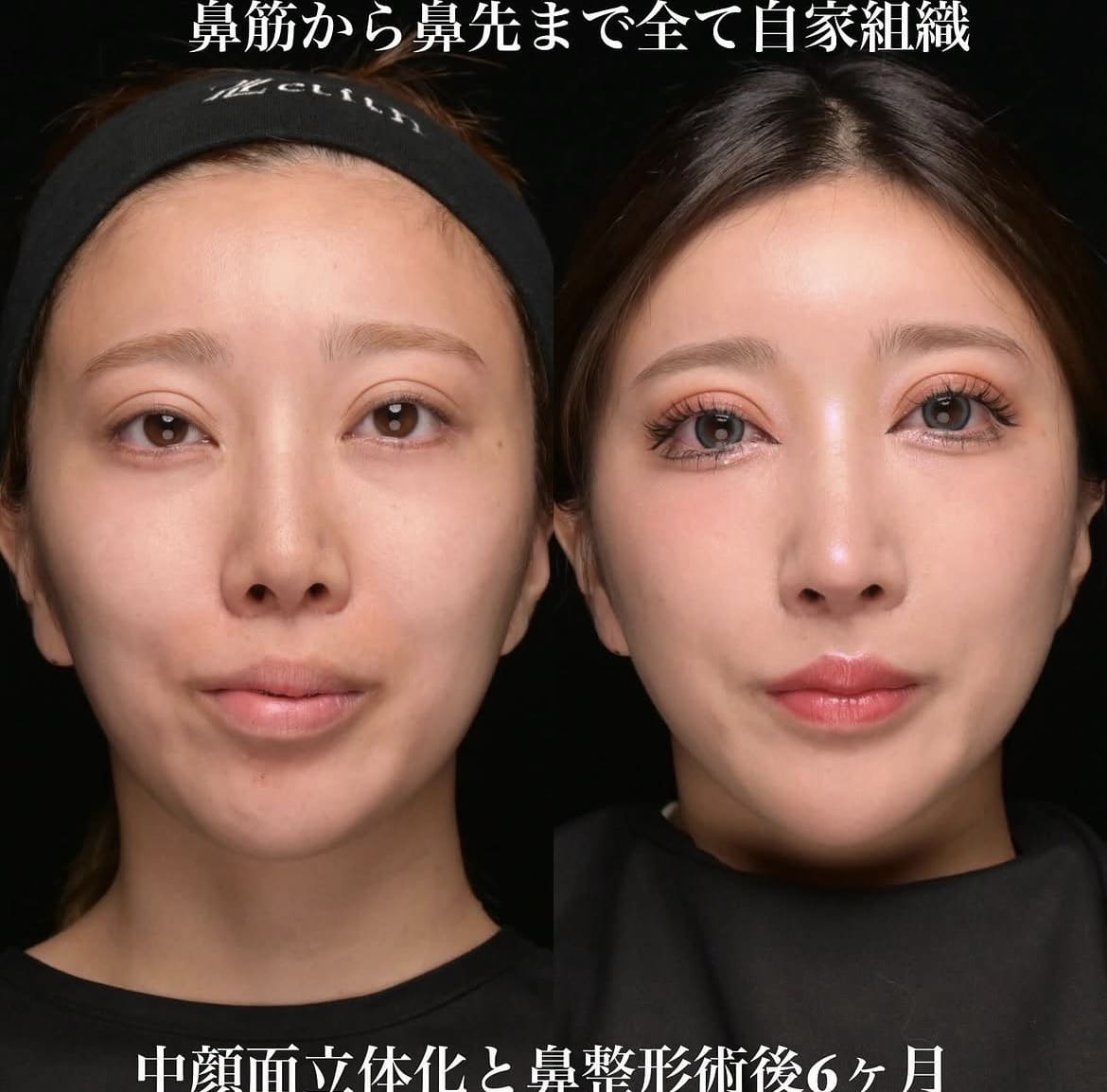 鼻整形のビフォーアフター写真