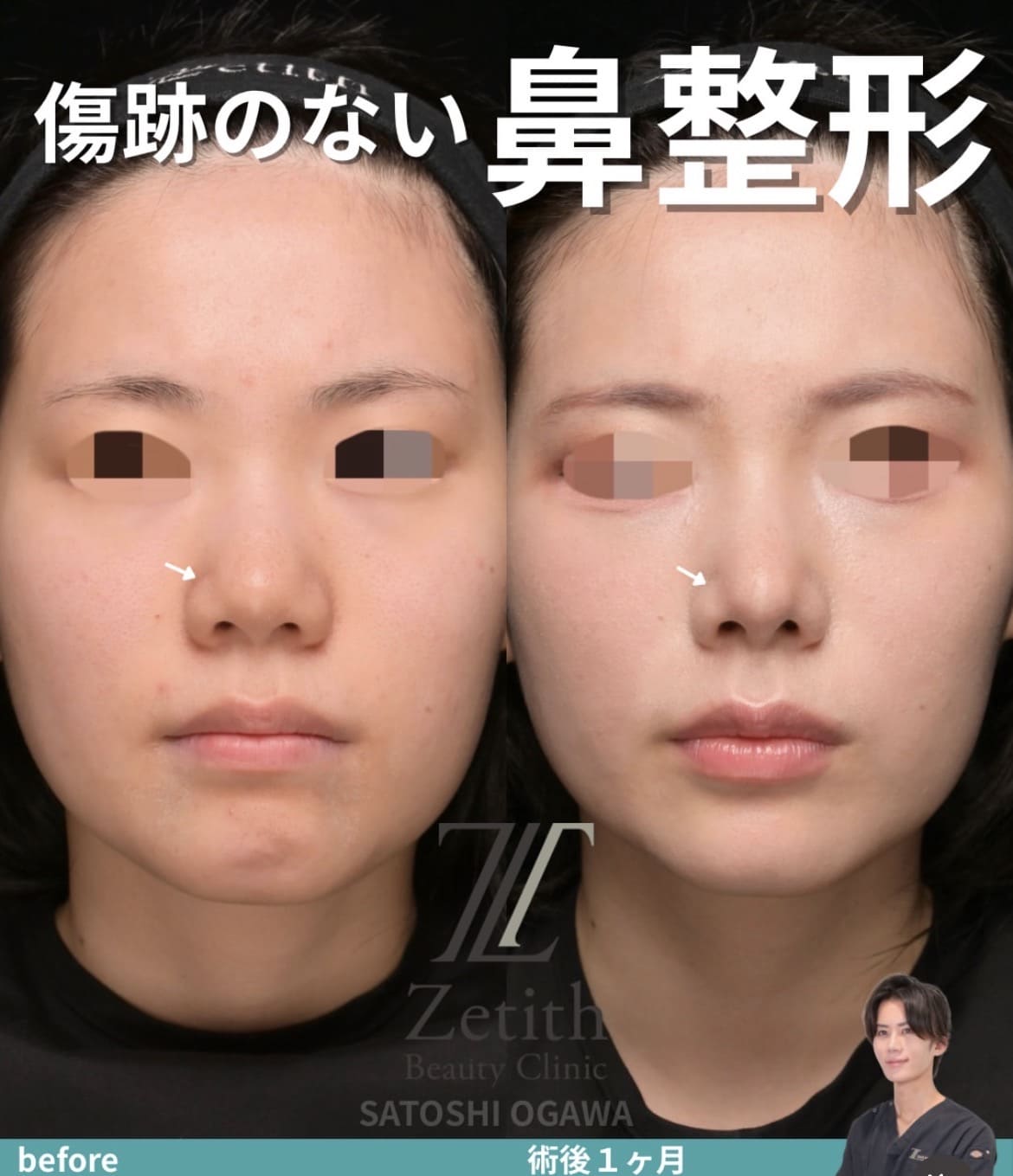 鼻整形ビフォーアフター写真