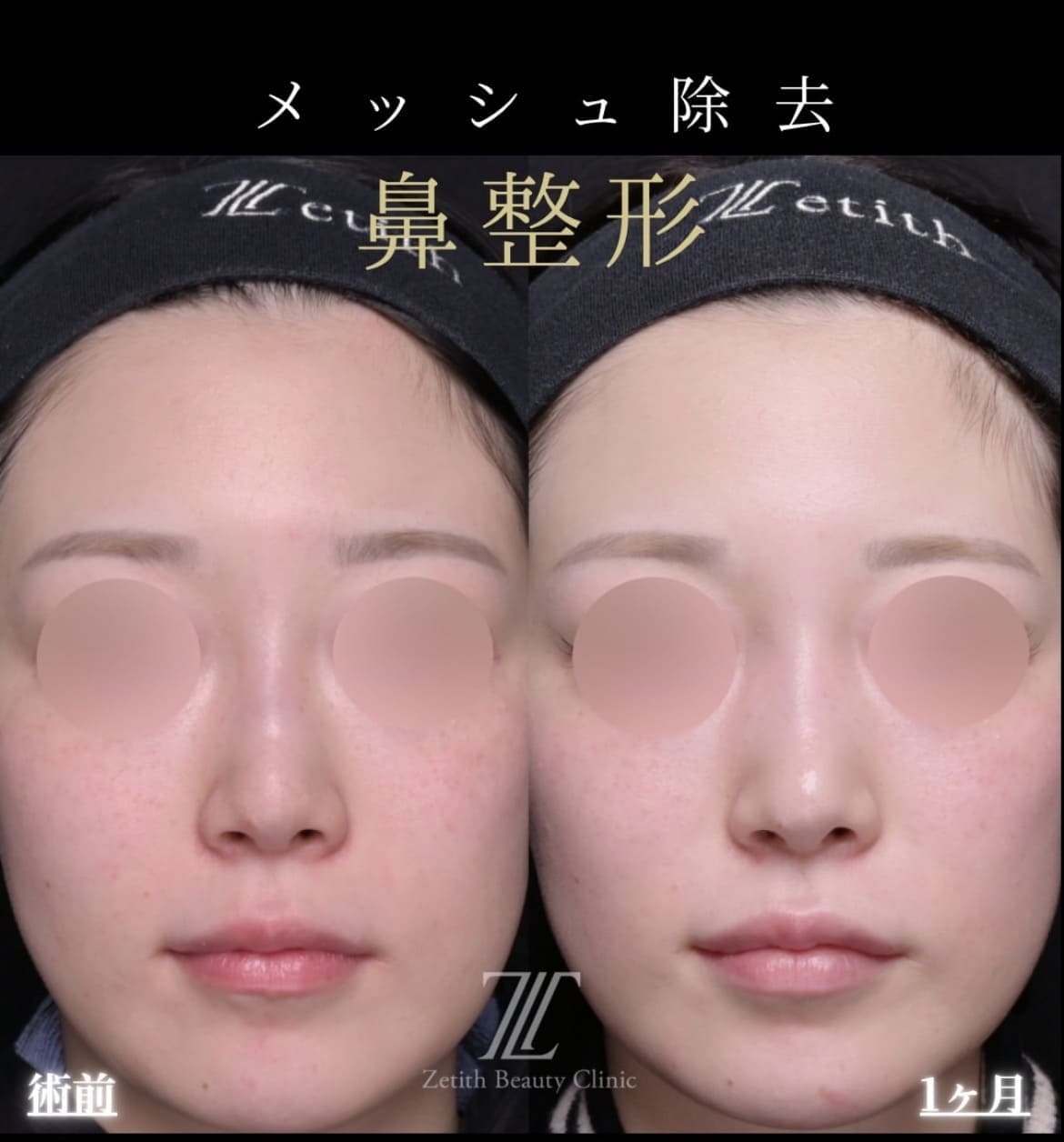 鼻整形のビフォーアフター写真