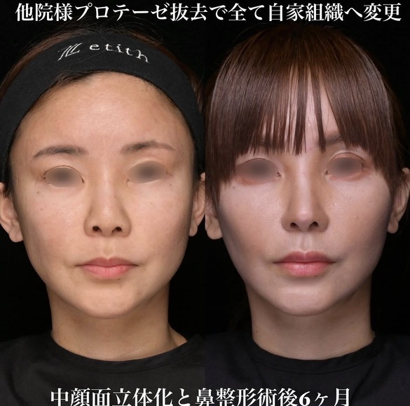 鼻整形のビフォーアフター写真