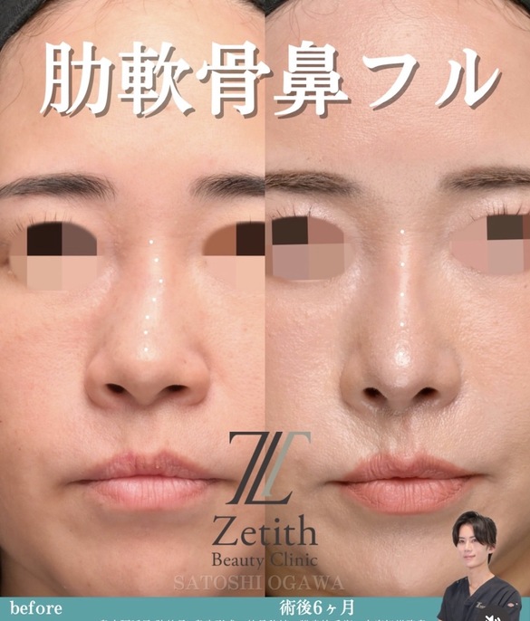 鼻整形のビフォーアフター写真